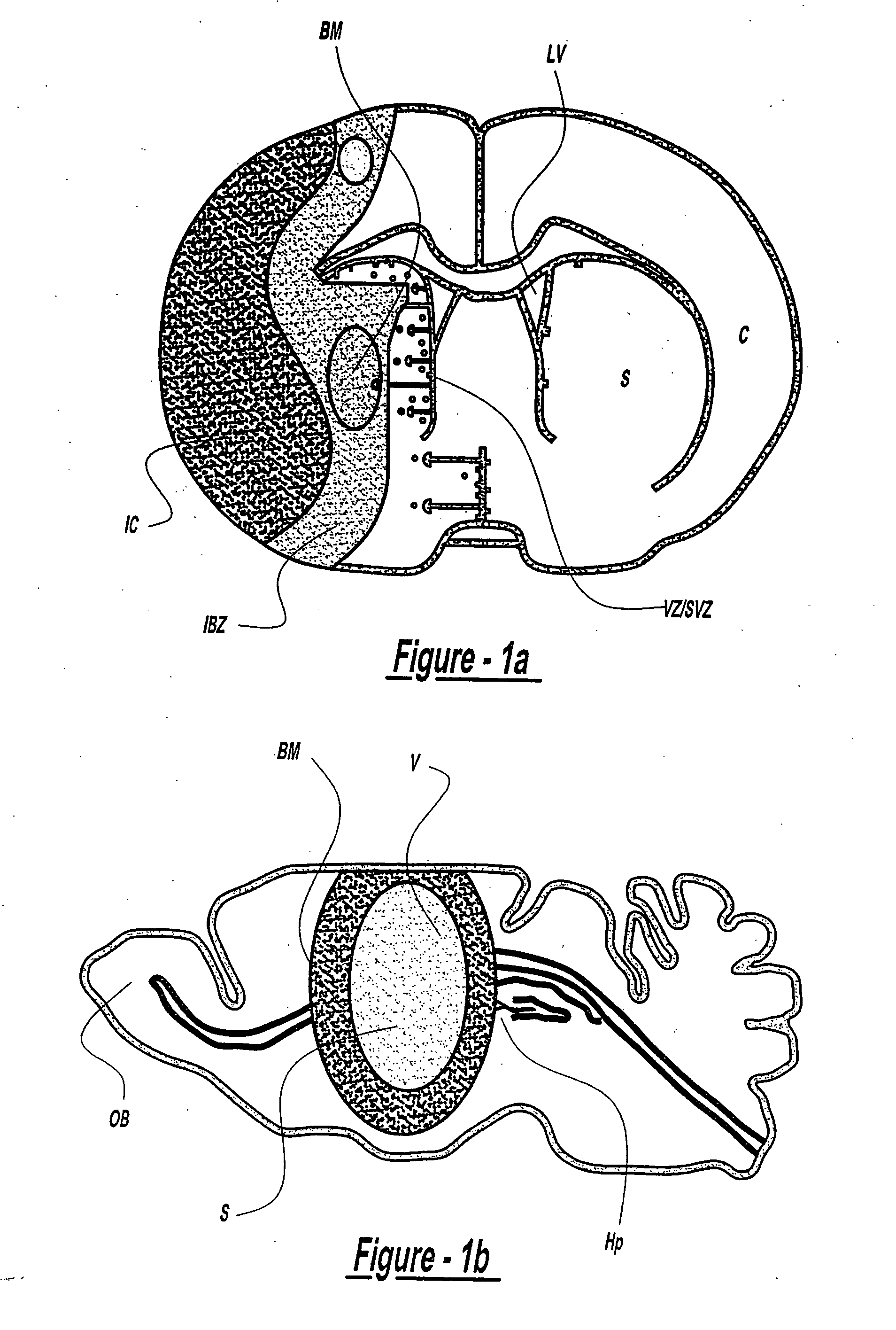 Bone marrow transplantation for treatment of stroke