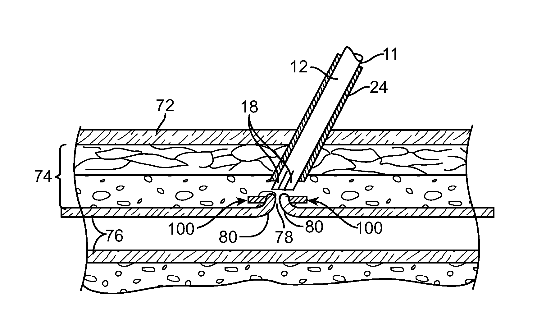 Mechanism and Method for Closing an Arteriotomy