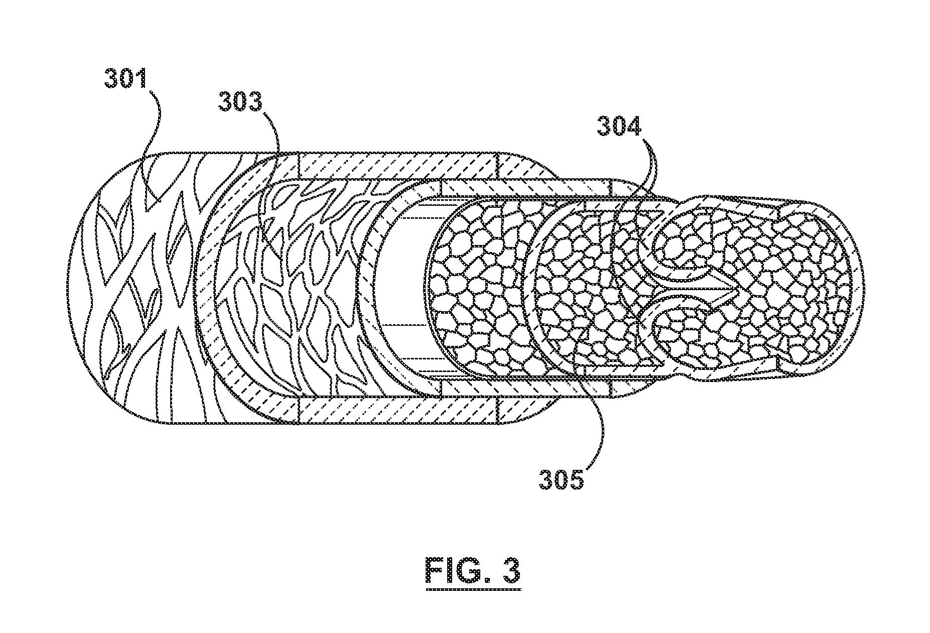 Percutaneous Methods and Apparatus for Creating Native Tissue Venous Valves