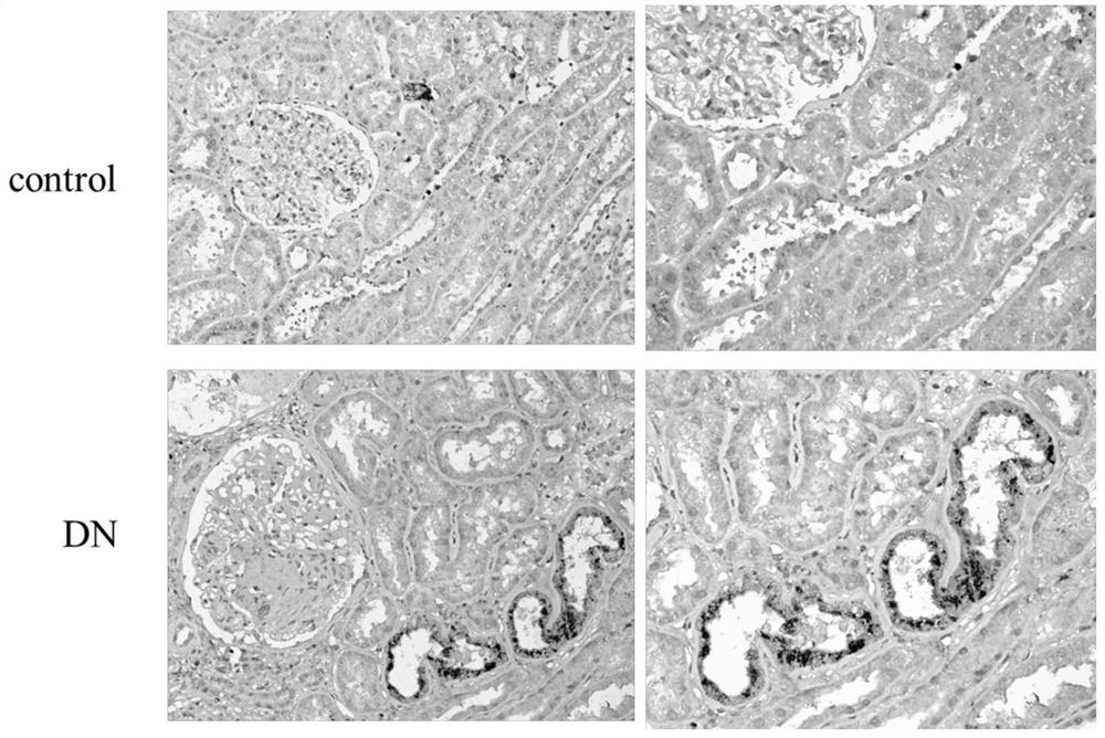 Use of secreted leukoproteinase inhibitor slpi as a prognostic marker for diabetic nephropathy dn