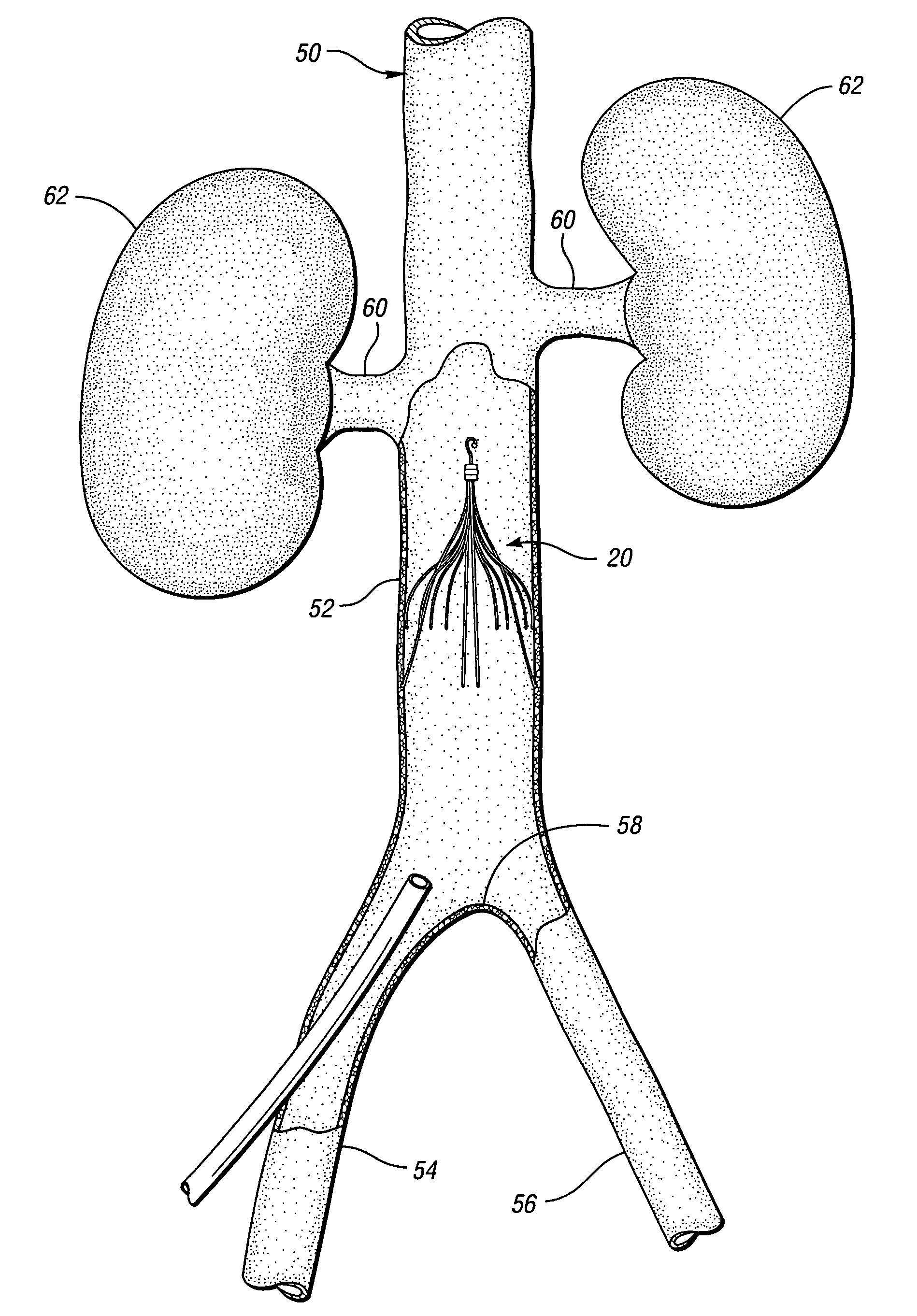 Removable vena cava filter with anchoring feature for reduced trauma