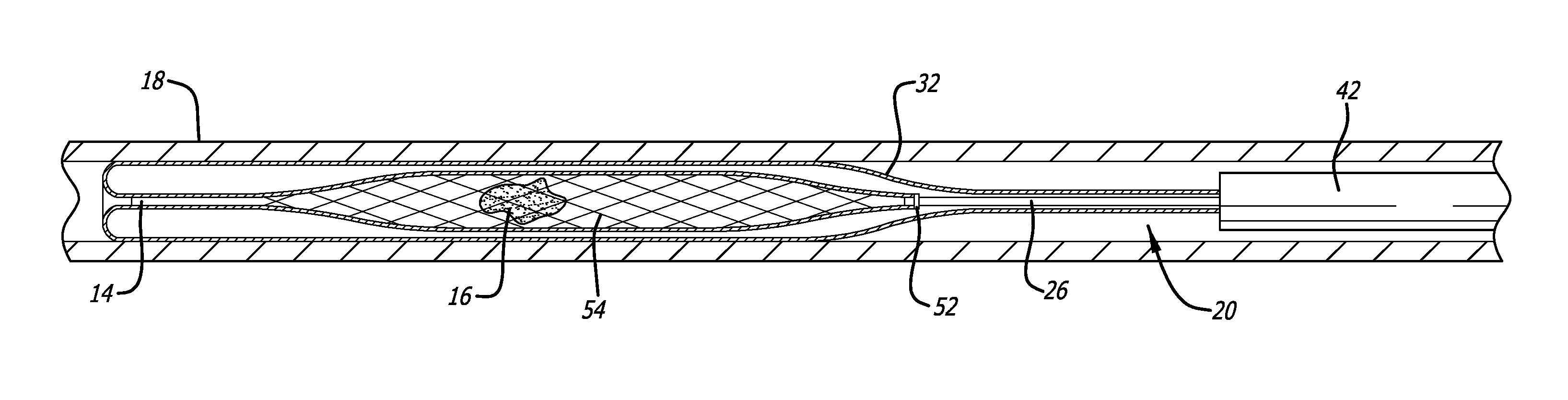 Ischemic stroke device