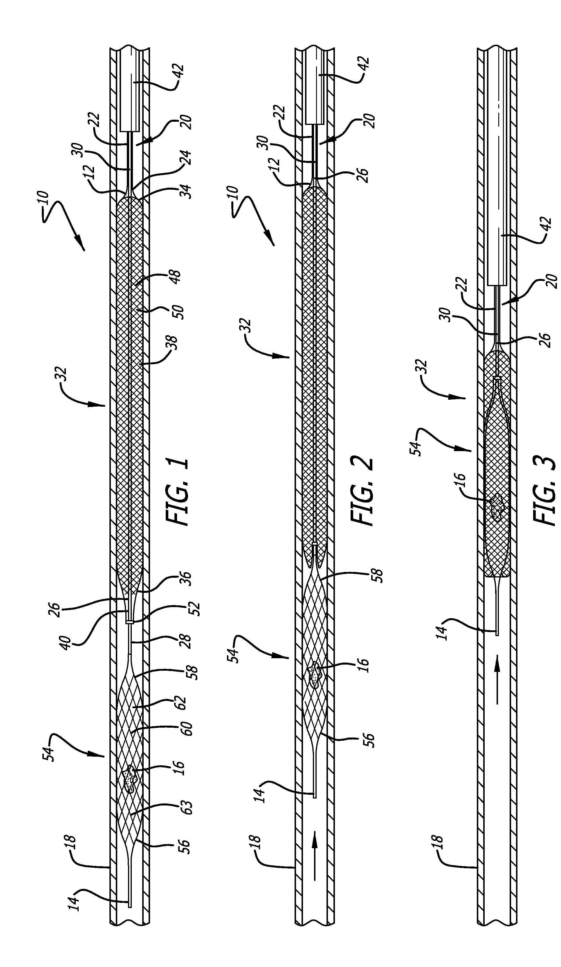 Ischemic stroke device