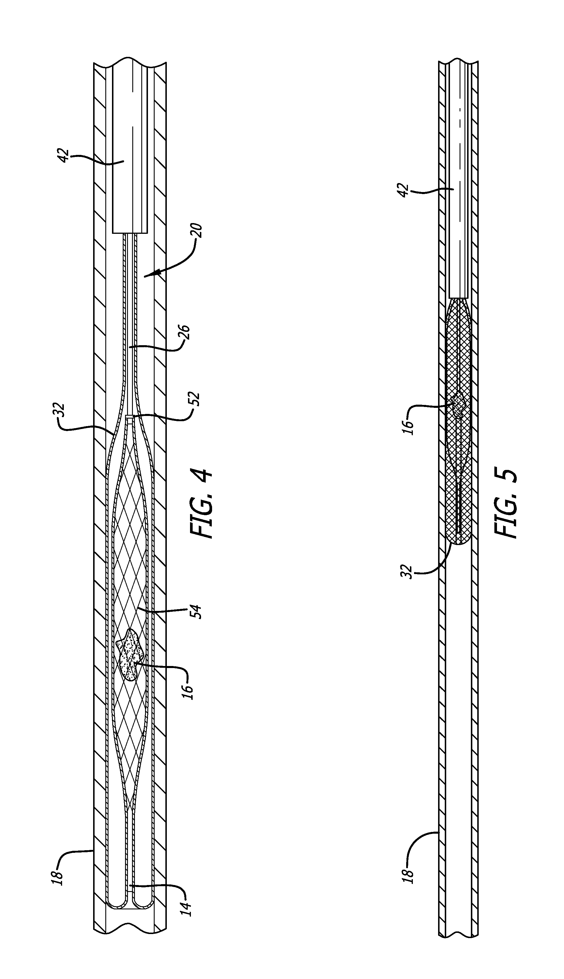 Ischemic stroke device