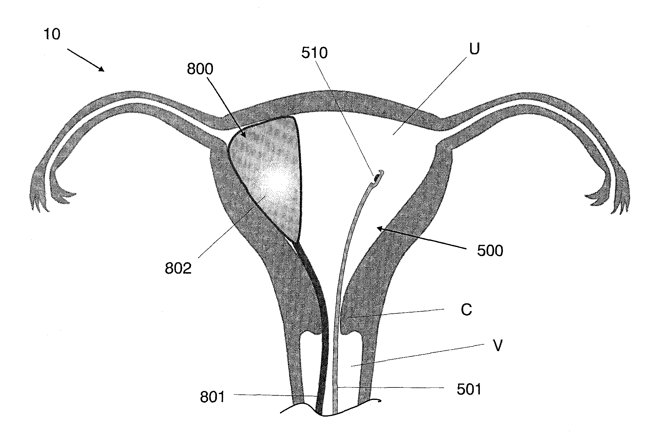 Systems and methods for preventing intravasation during intrauterine procedures