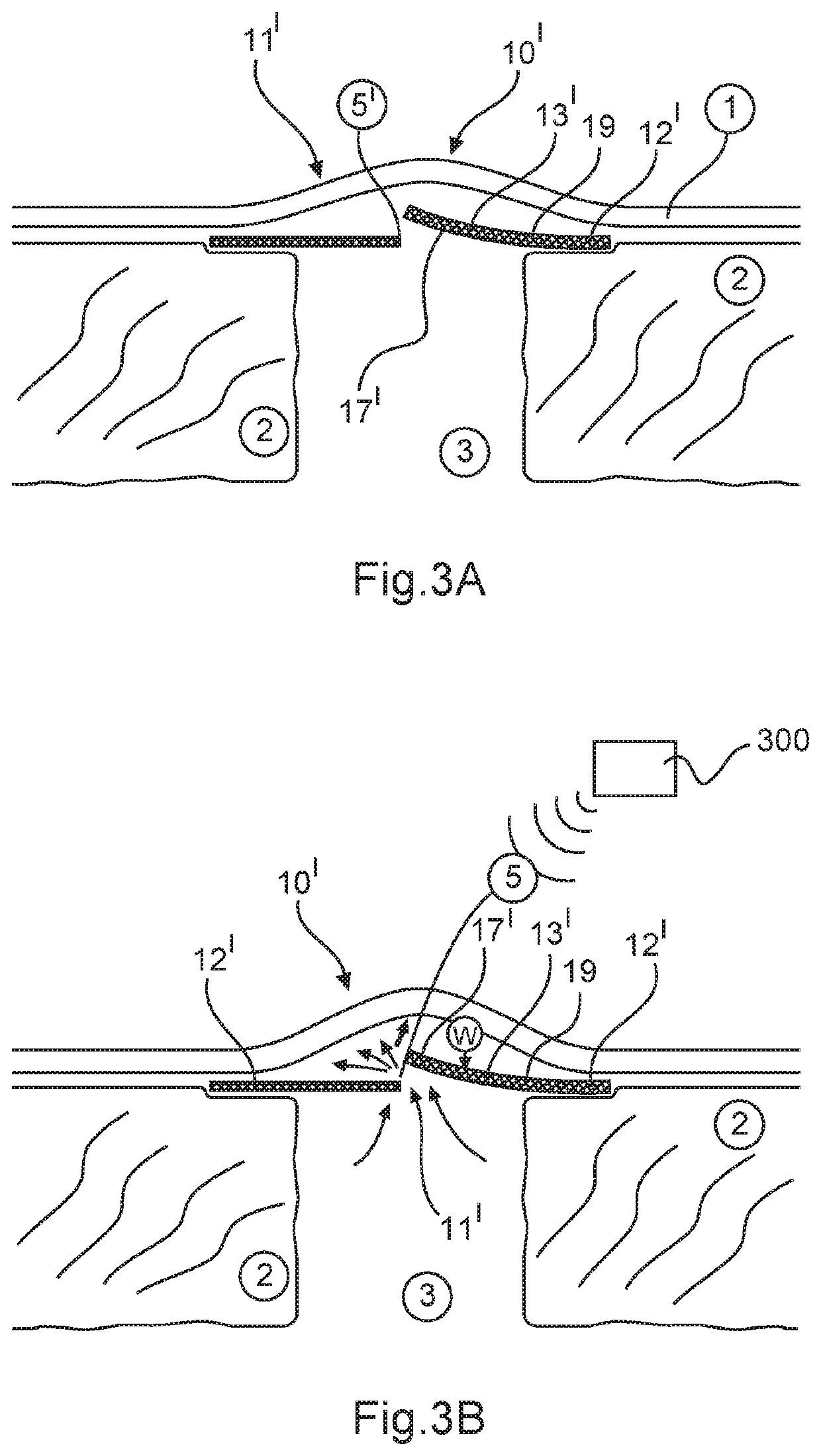 Glaucoma drainage implant