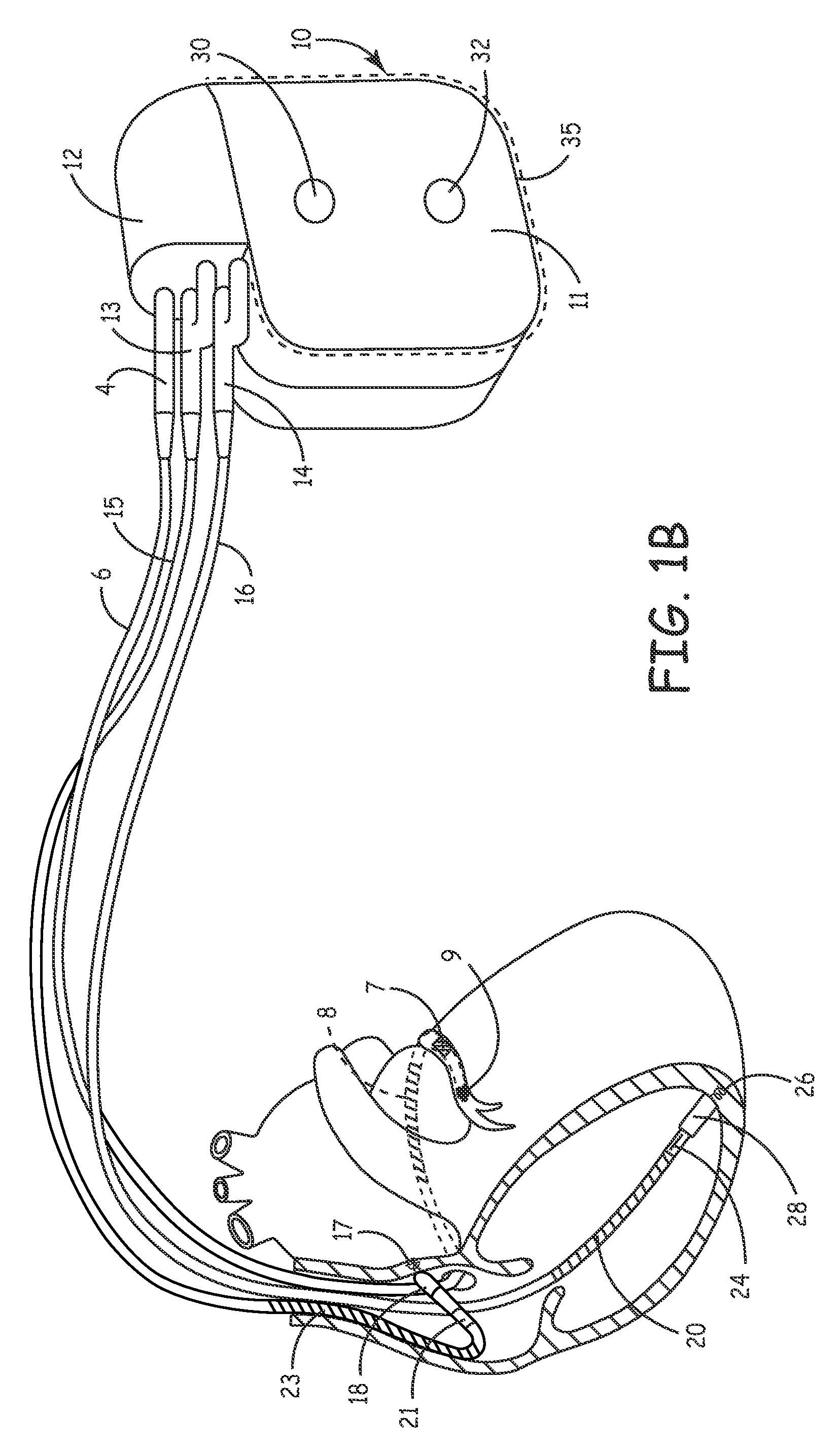 Secure and efficacious therapy delivery for an extra-systolic stimulation pacing engine