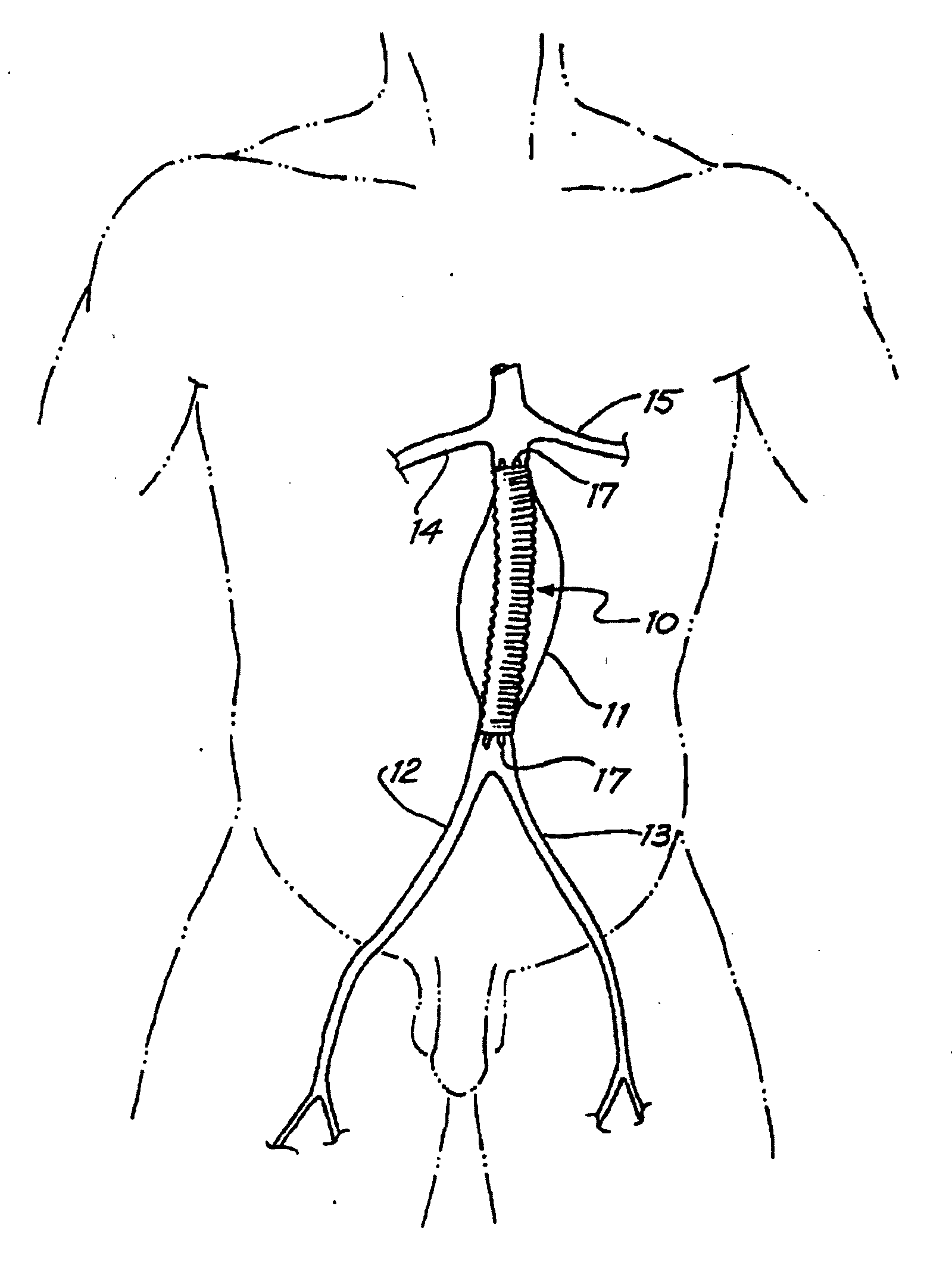 Intraluminal Graft