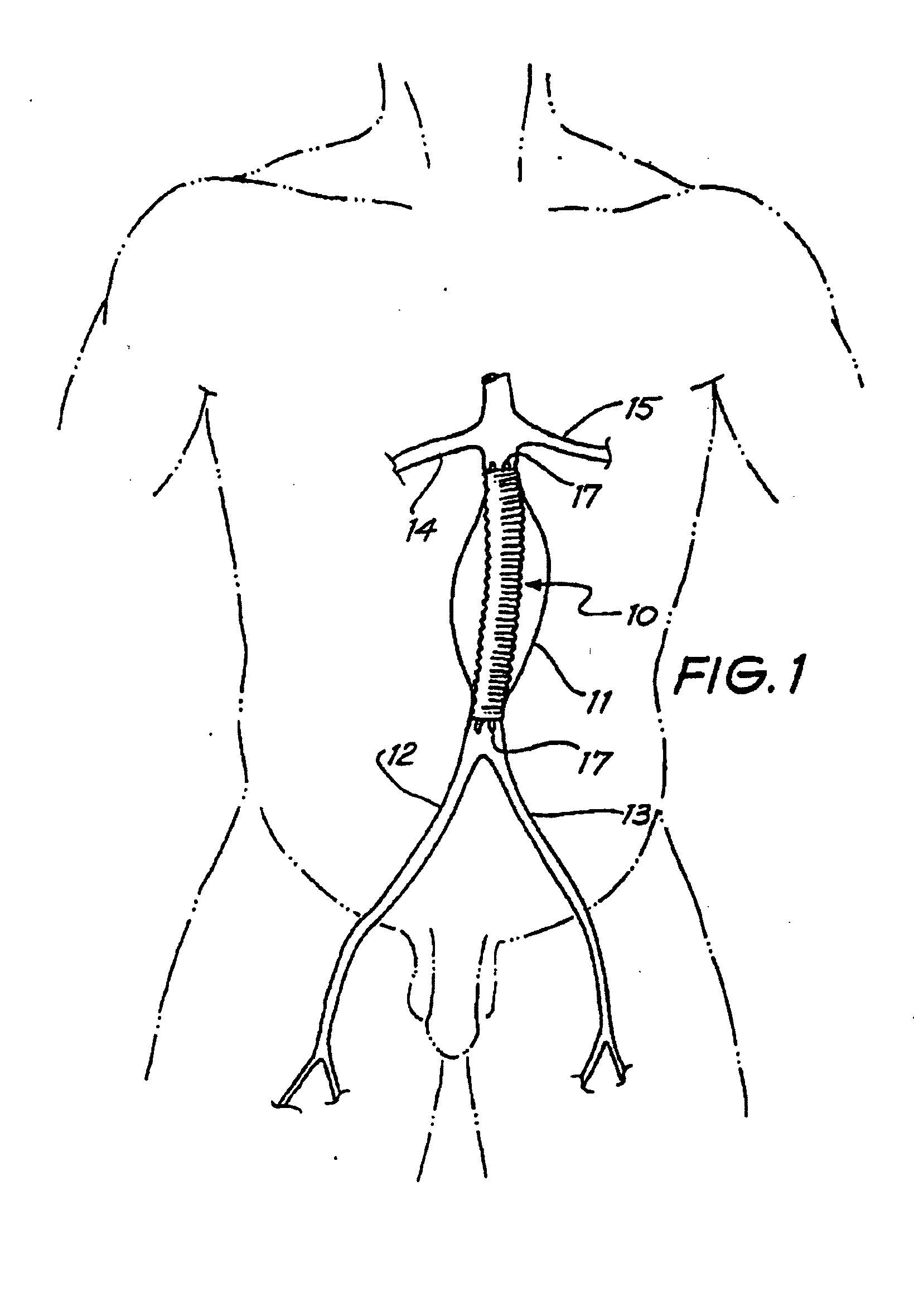 Intraluminal Graft