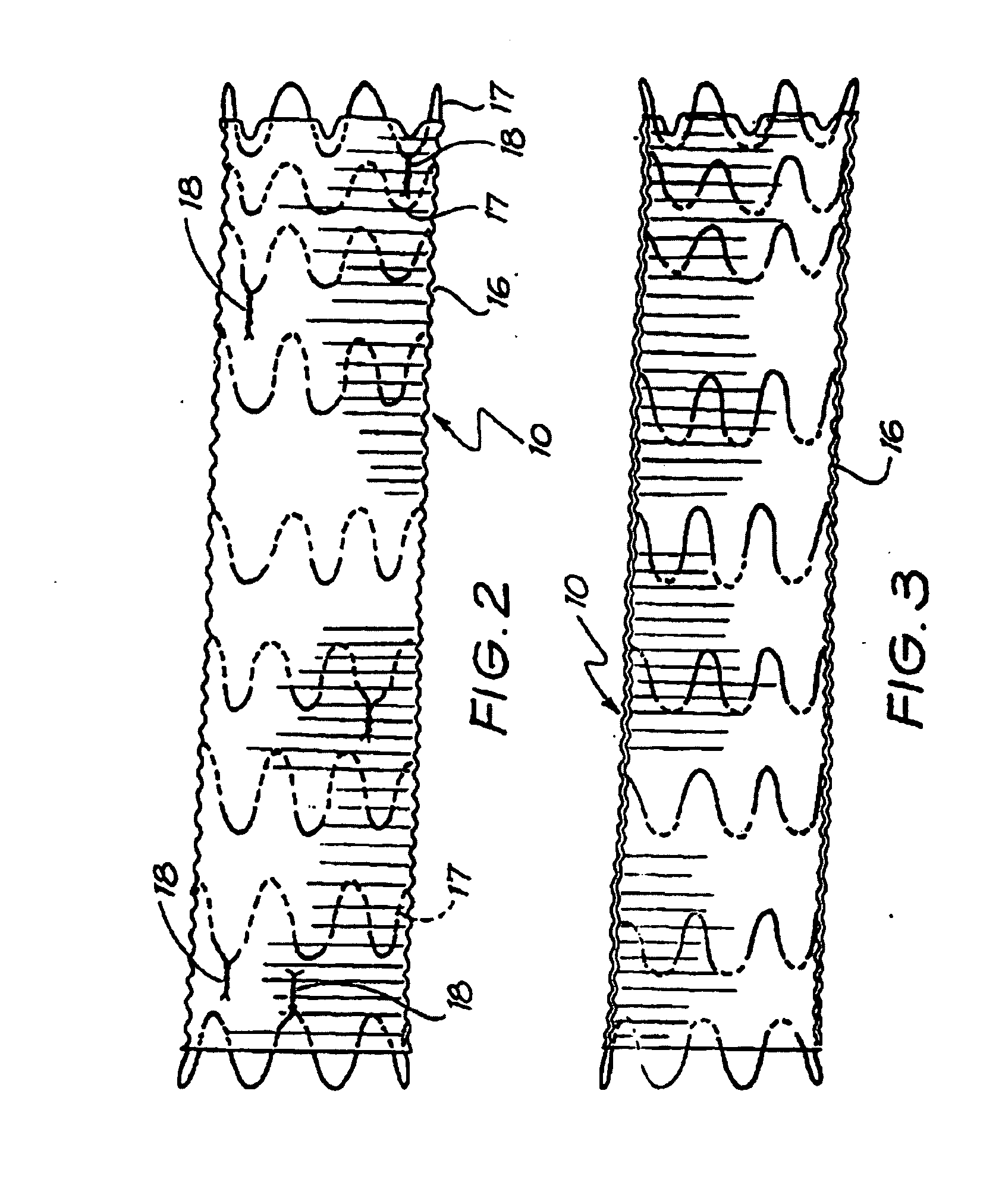 Intraluminal Graft