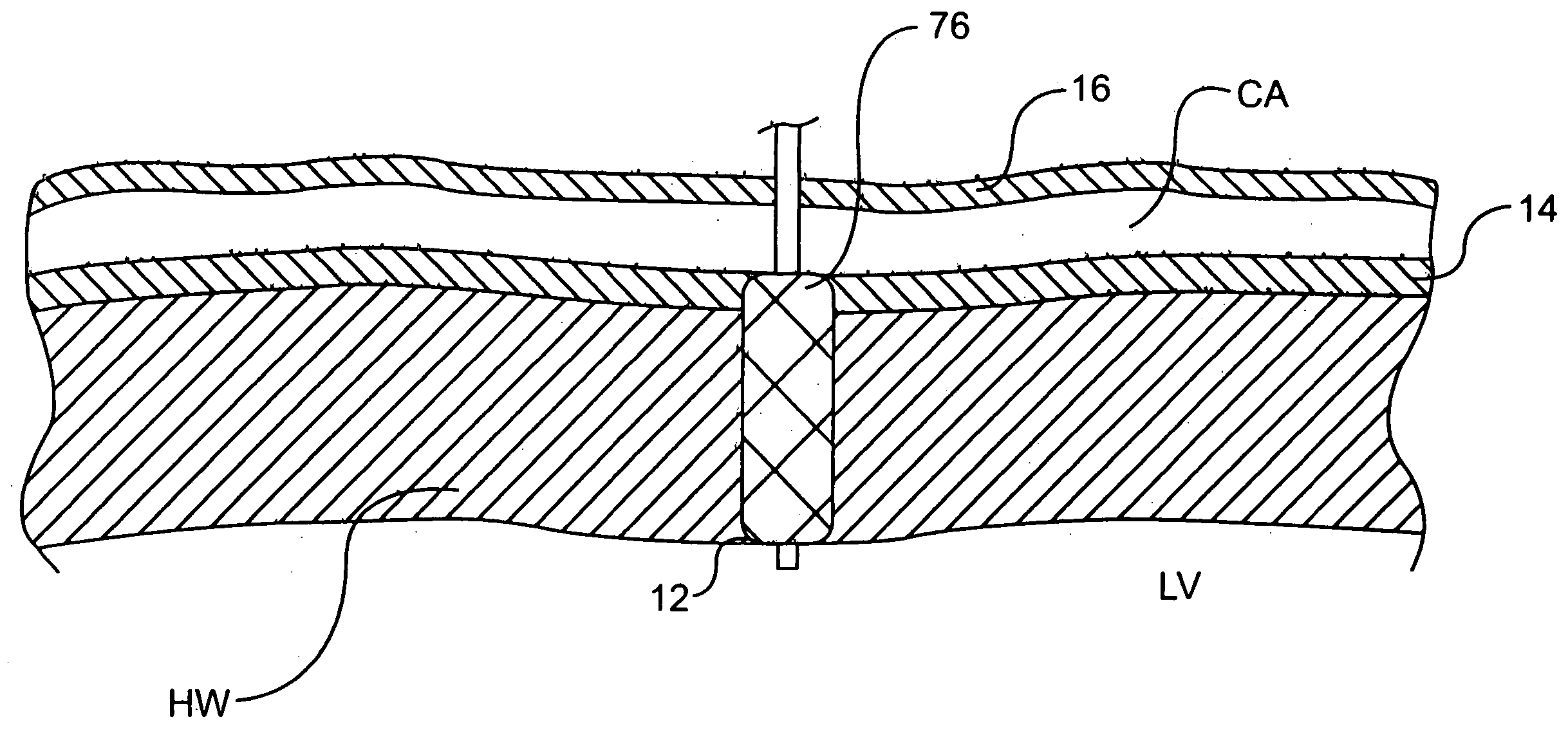 Methods and devices for delivering a ventricular stent