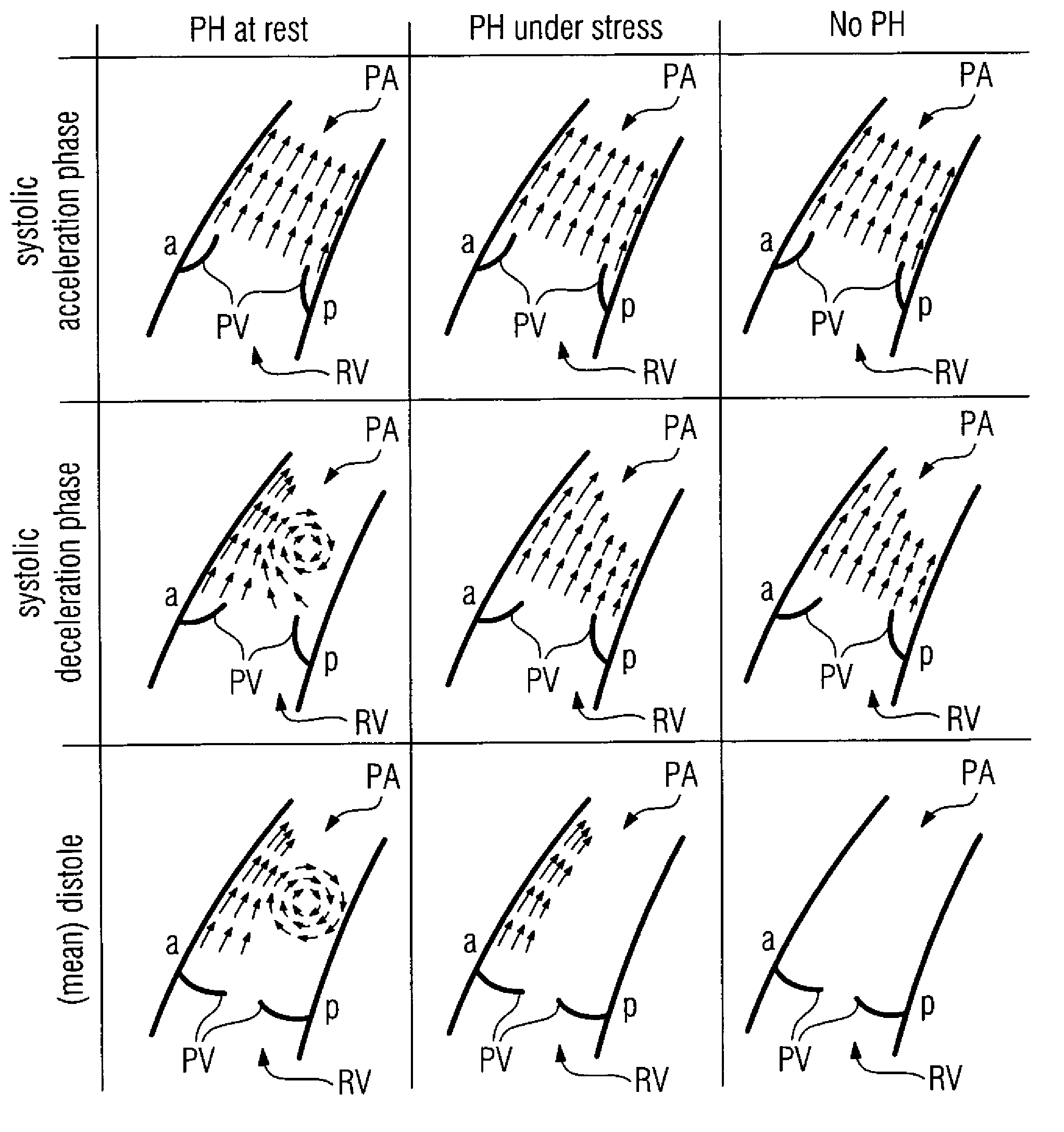 Method and medical apparatus for measuring pulmonary artery blood flow