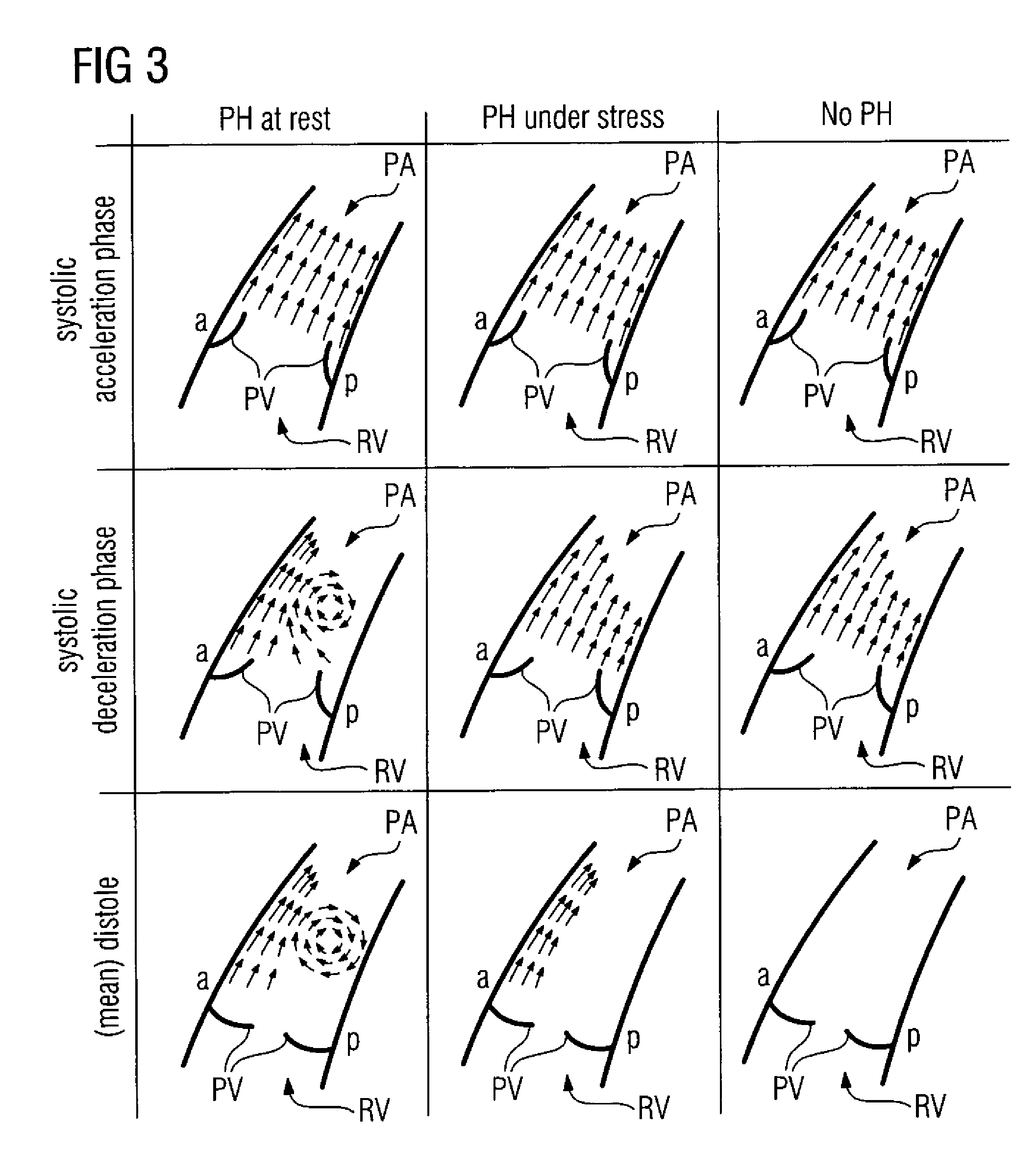 Method and medical apparatus for measuring pulmonary artery blood flow