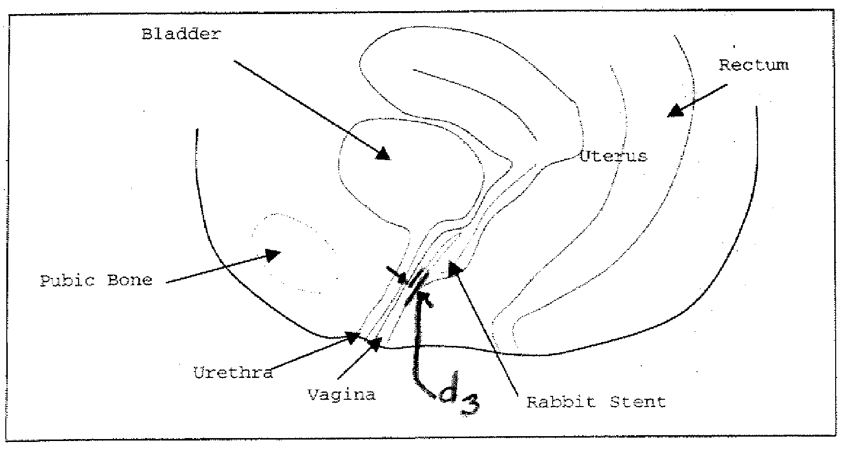 Method of treating urinary incontinence