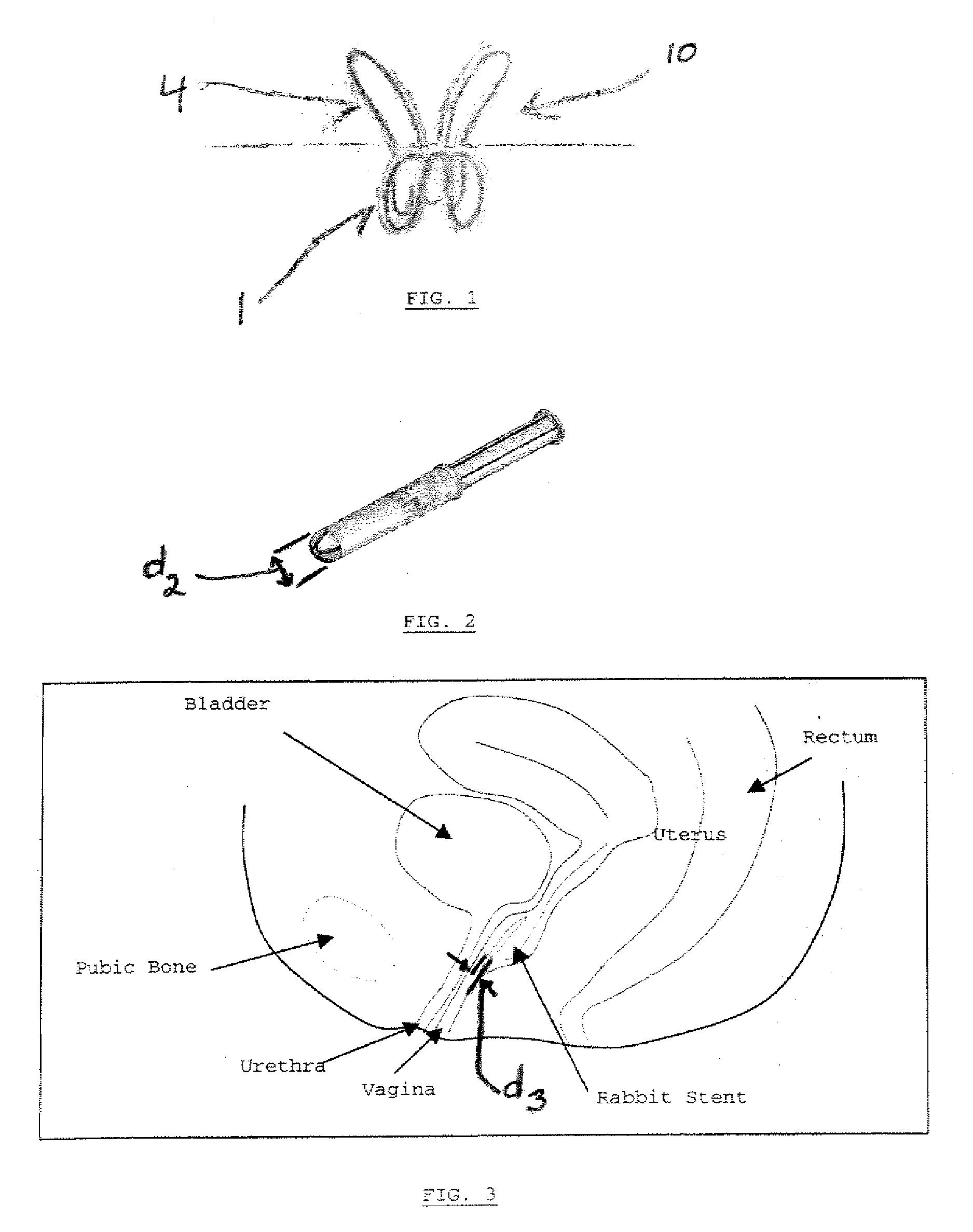 Method of treating urinary incontinence