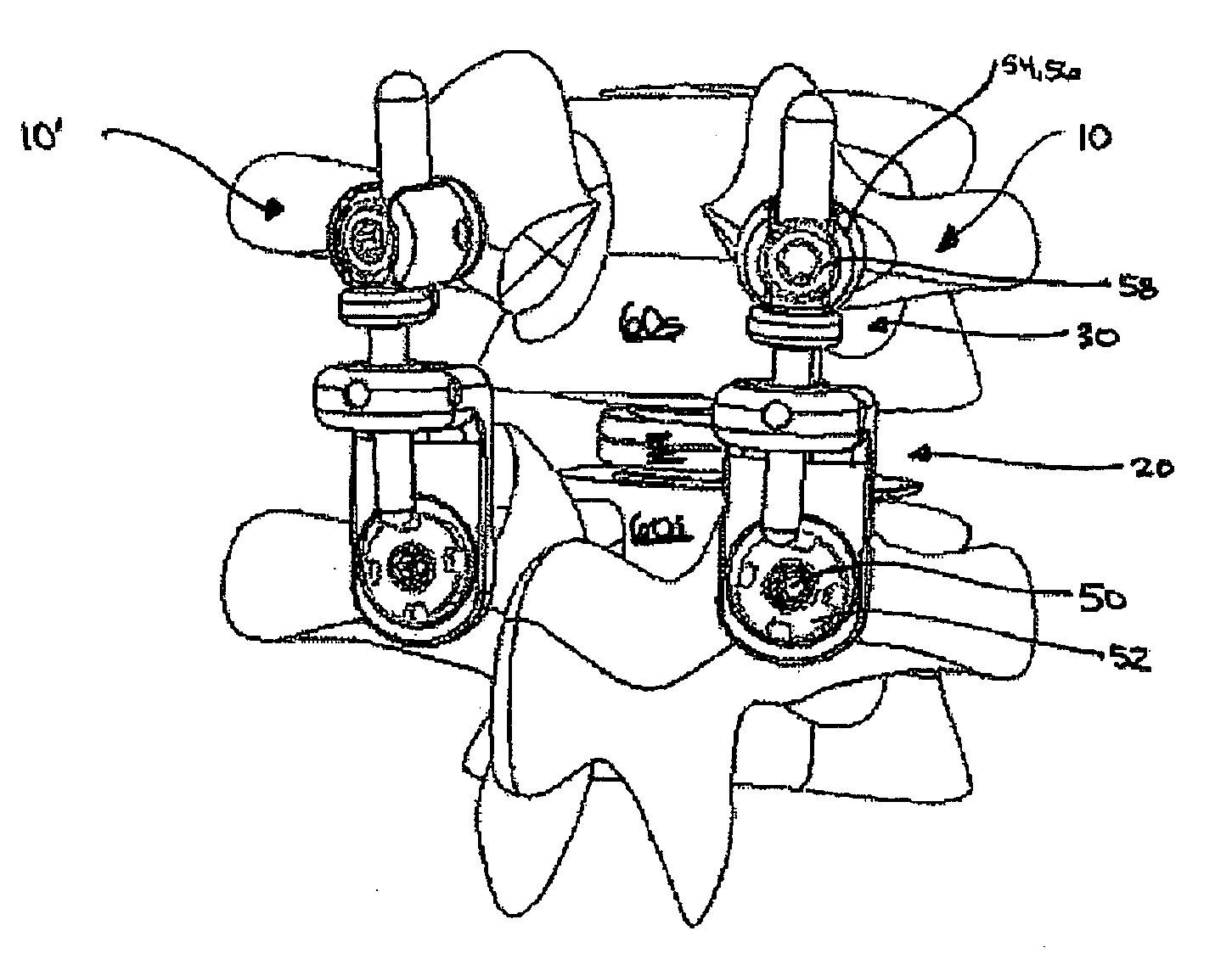 Artificial facet joint