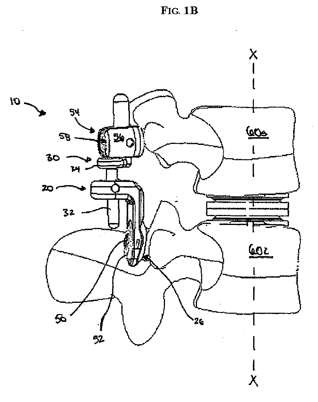 Artificial facet joint