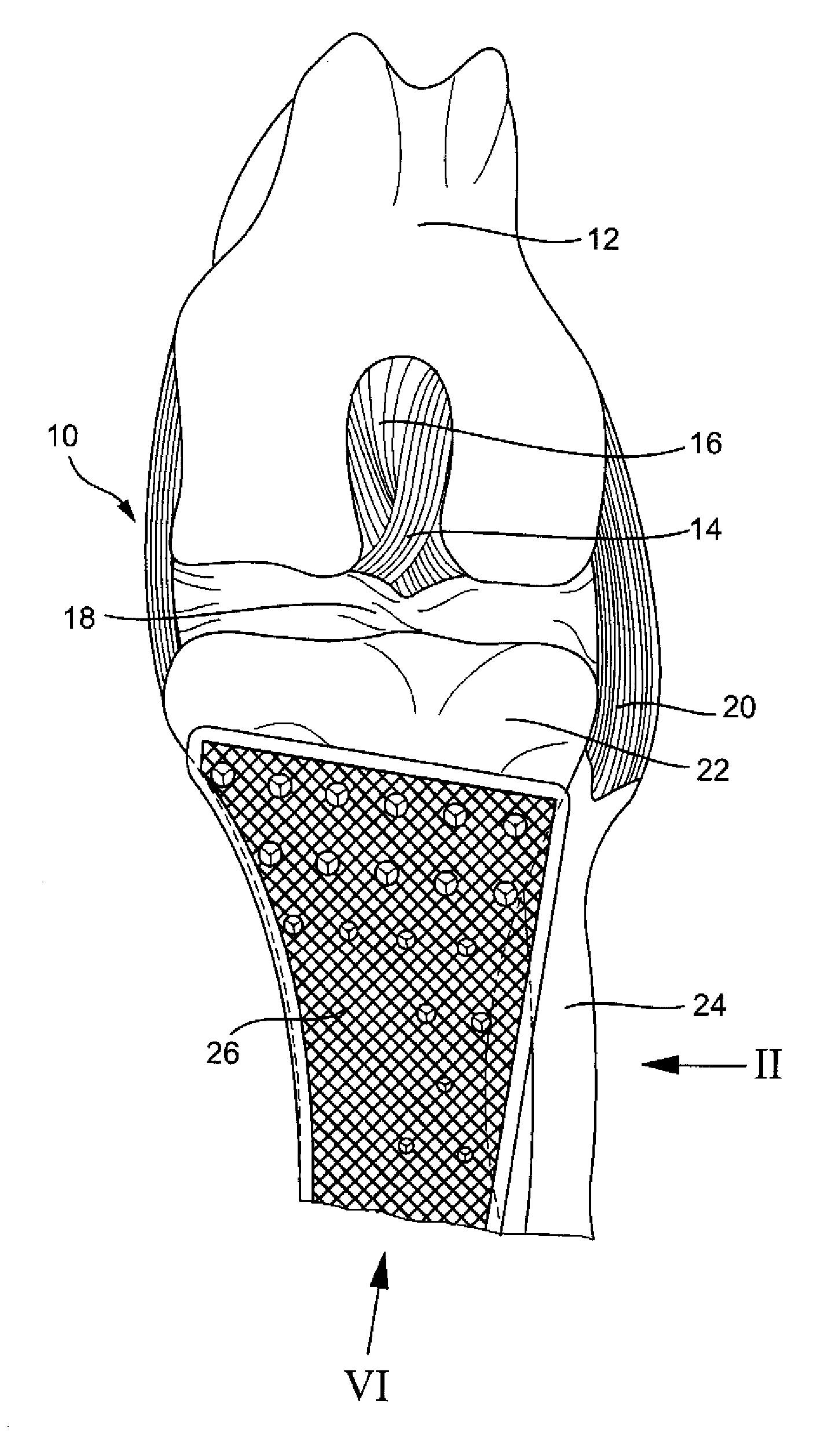 Tibia implant for tightening the patella tendons