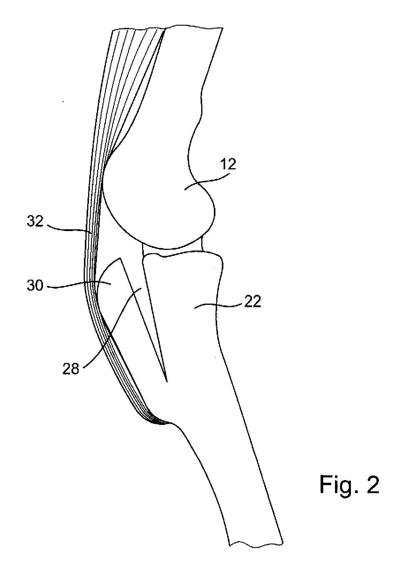 Tibia implant for tightening the patella tendons