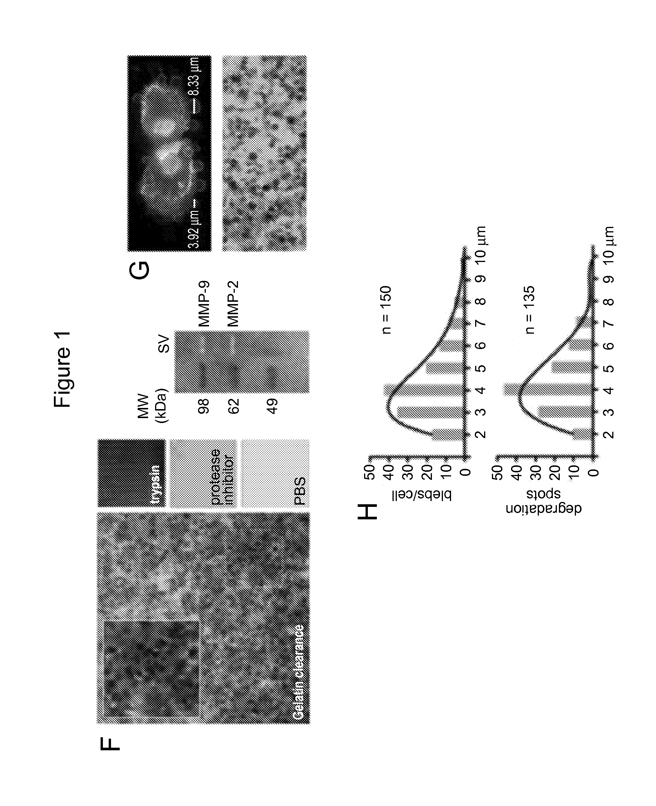 Large oncosomes in human tumors and in circulation in patients with cancer