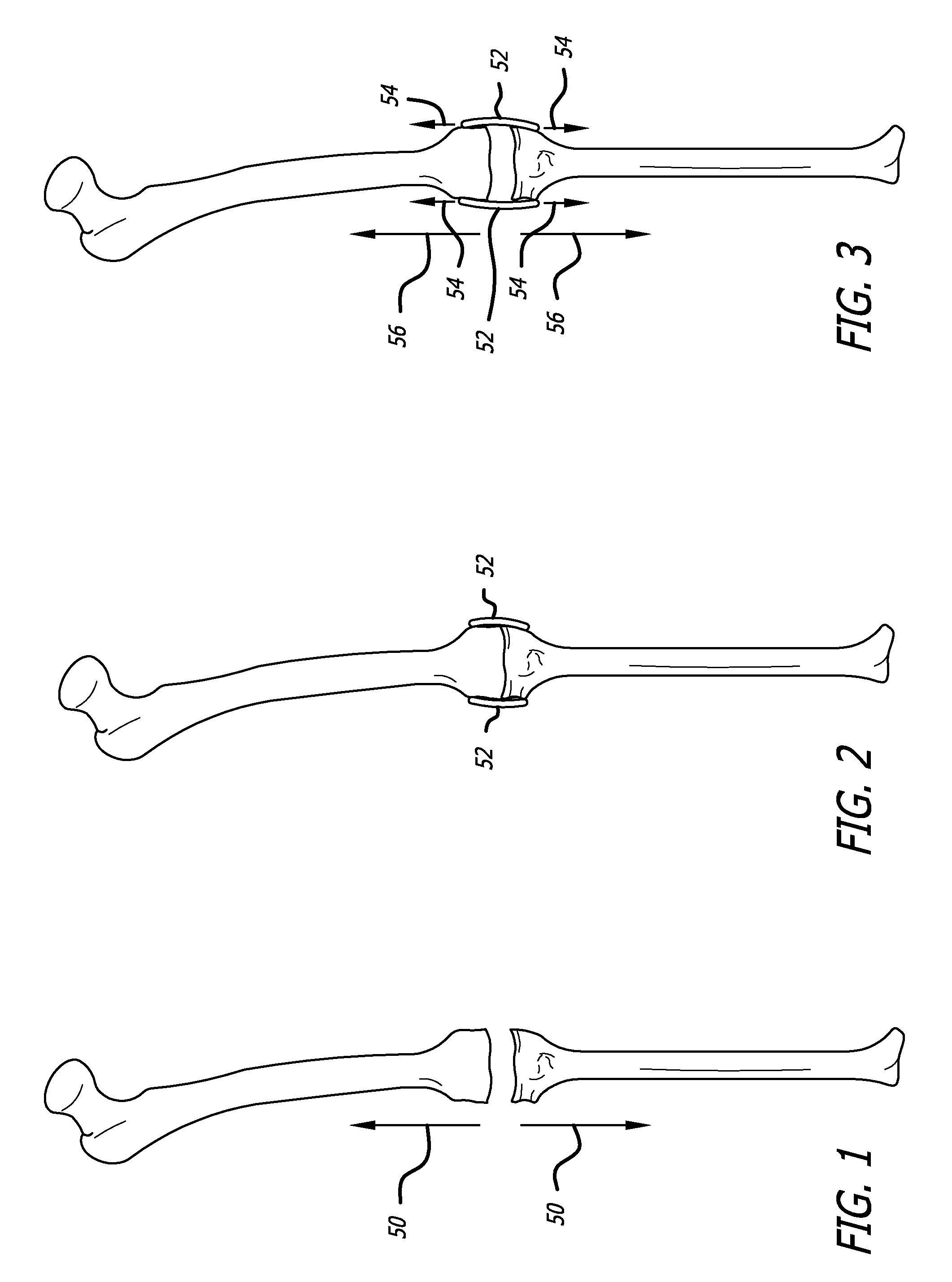 Extra-articular implantable mechanical energy absorbing systems and implantation method