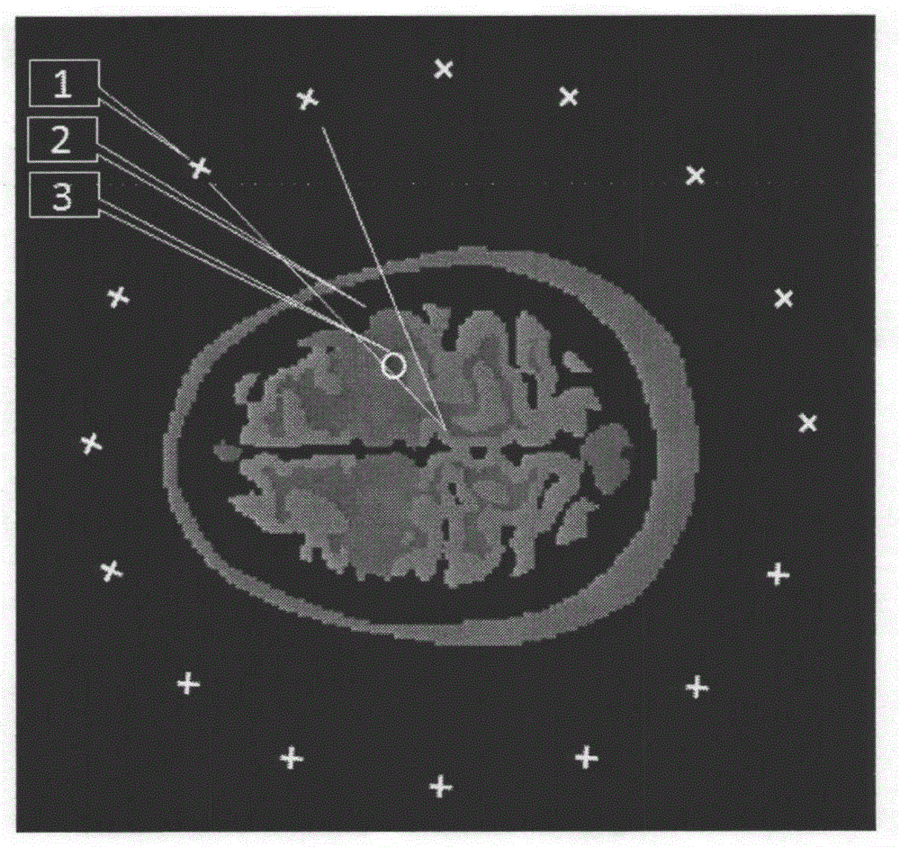 Microwave detection system for complex foreign matters in vivo based on template signal similarity