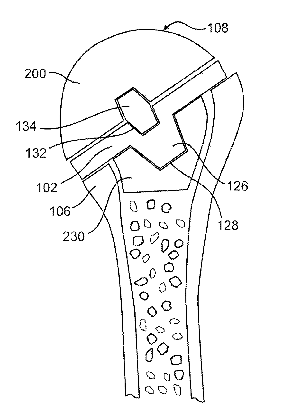 Humeral joint replacement component