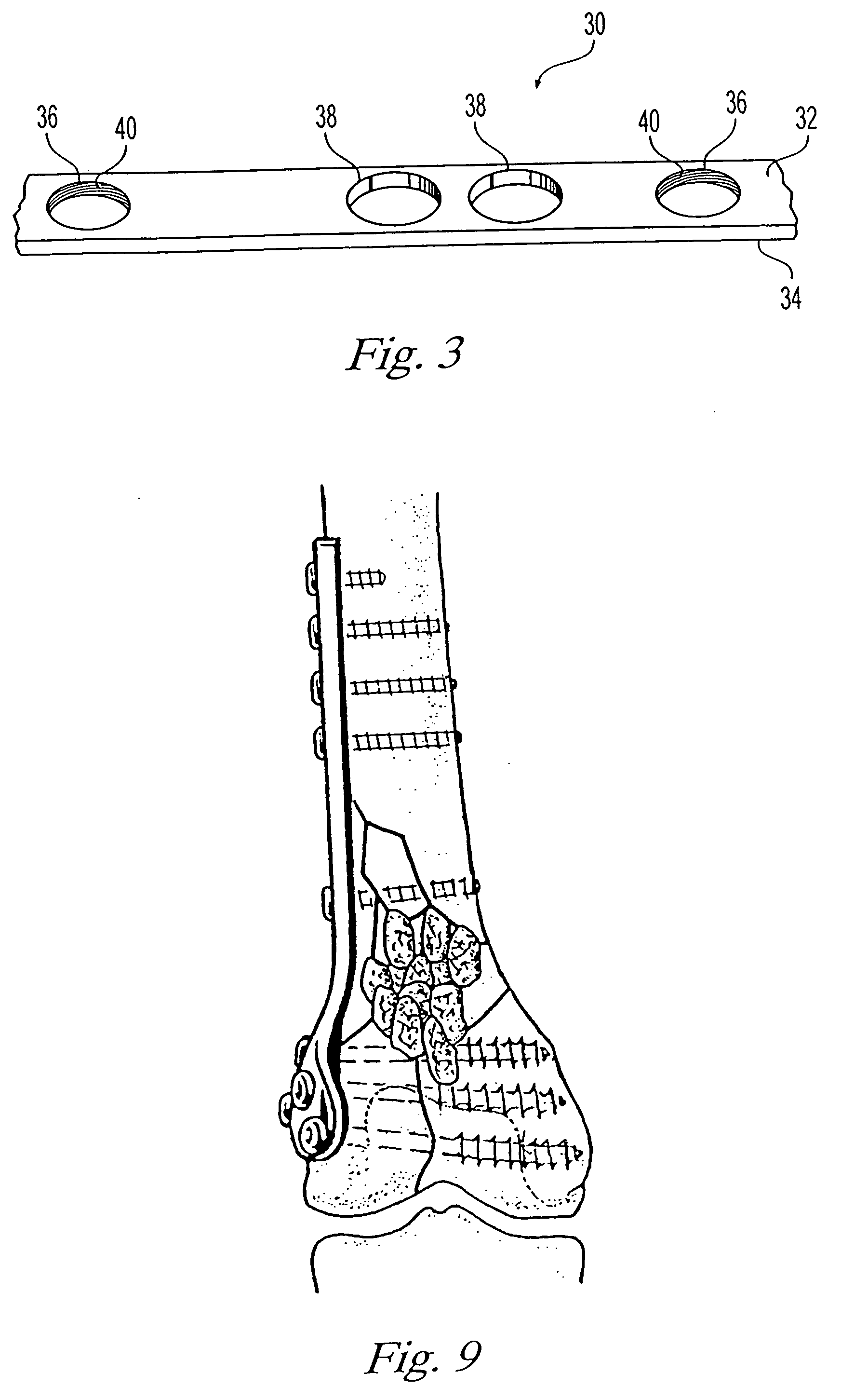 Bone plating system