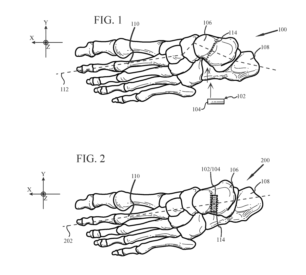 System and method for non-binding allograft subtalar joint implant