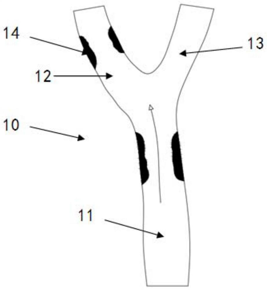 Hybrid braided stent