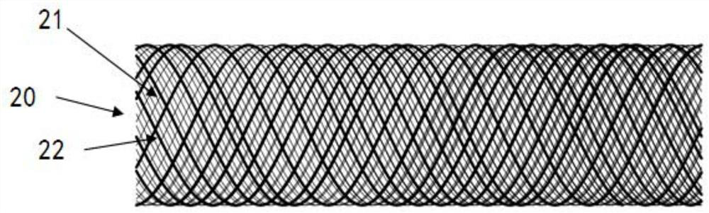 Hybrid braided stent