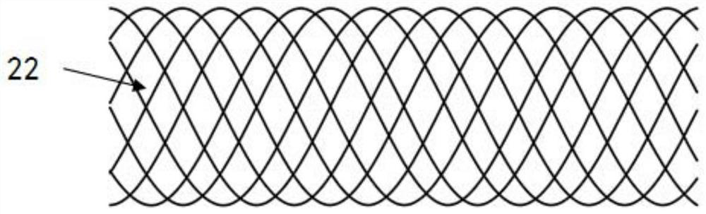 Hybrid braided stent