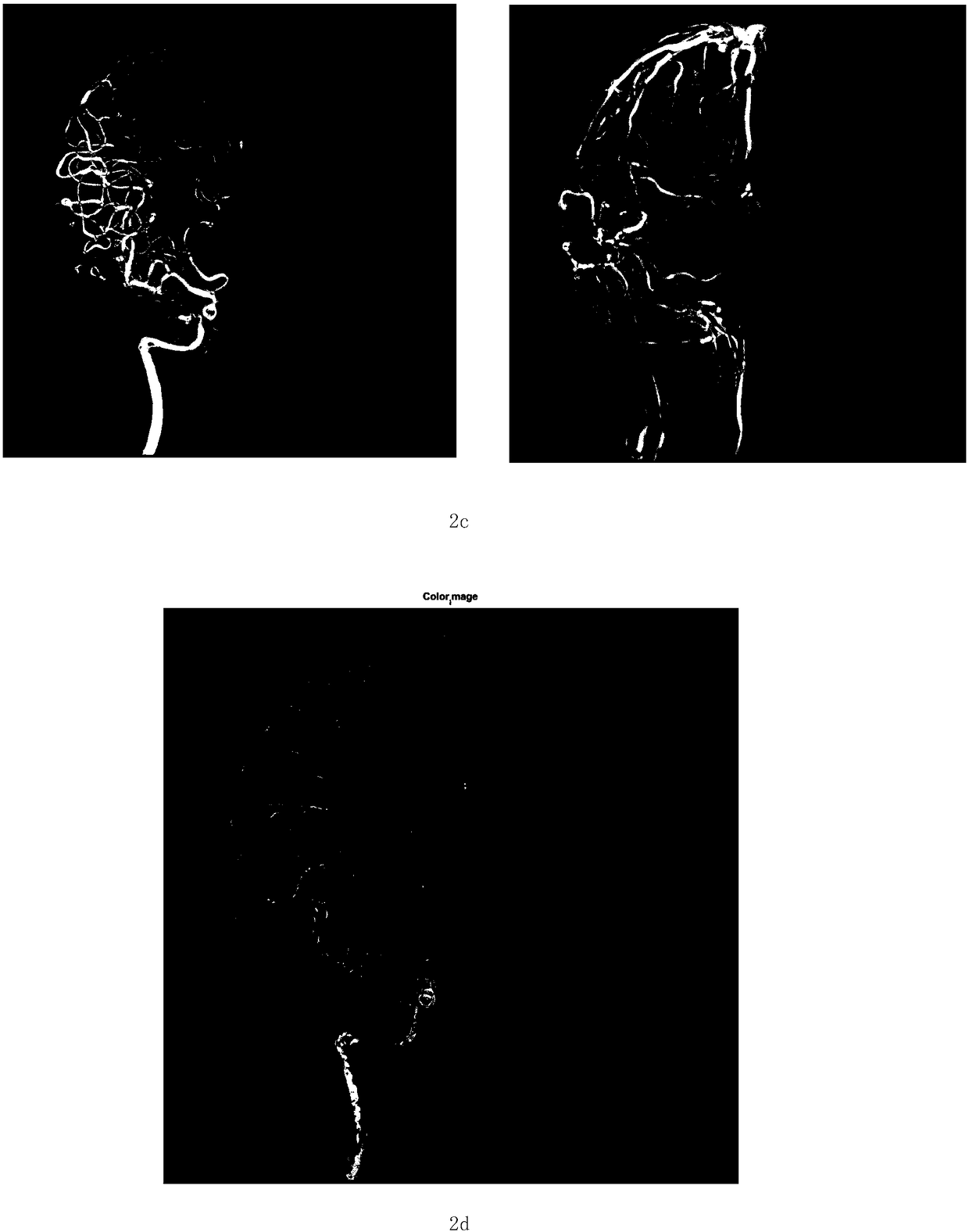 Multi-frame image blood vessel feature identification and information fusion-based color coding method