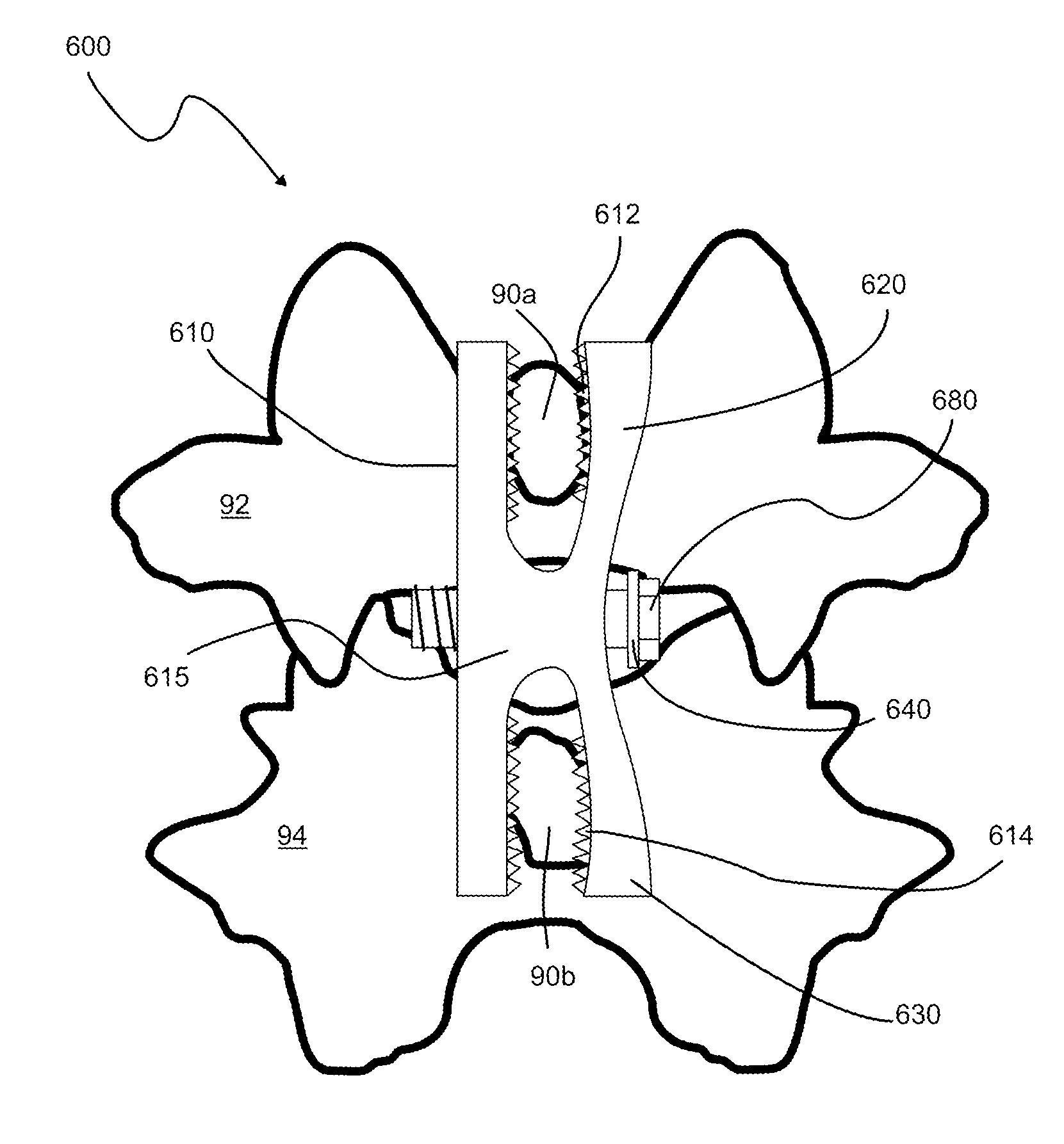 Spinous process fixation implant