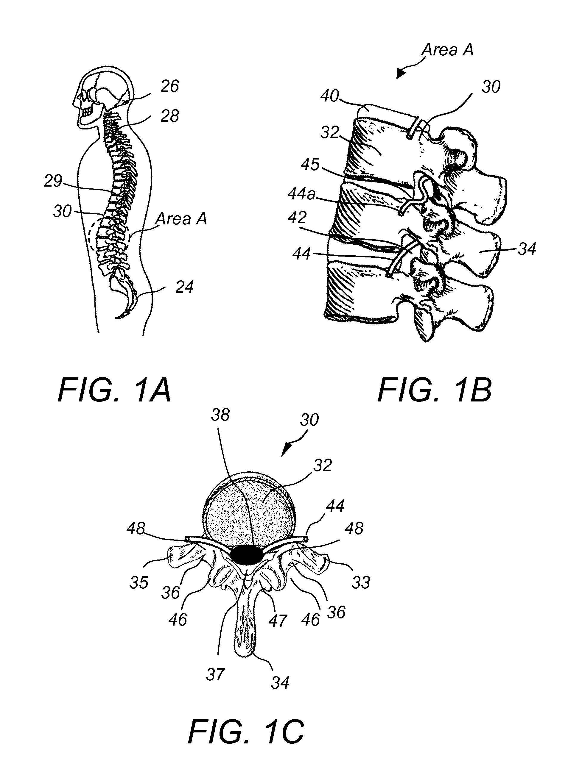 Spinous process fixation implant