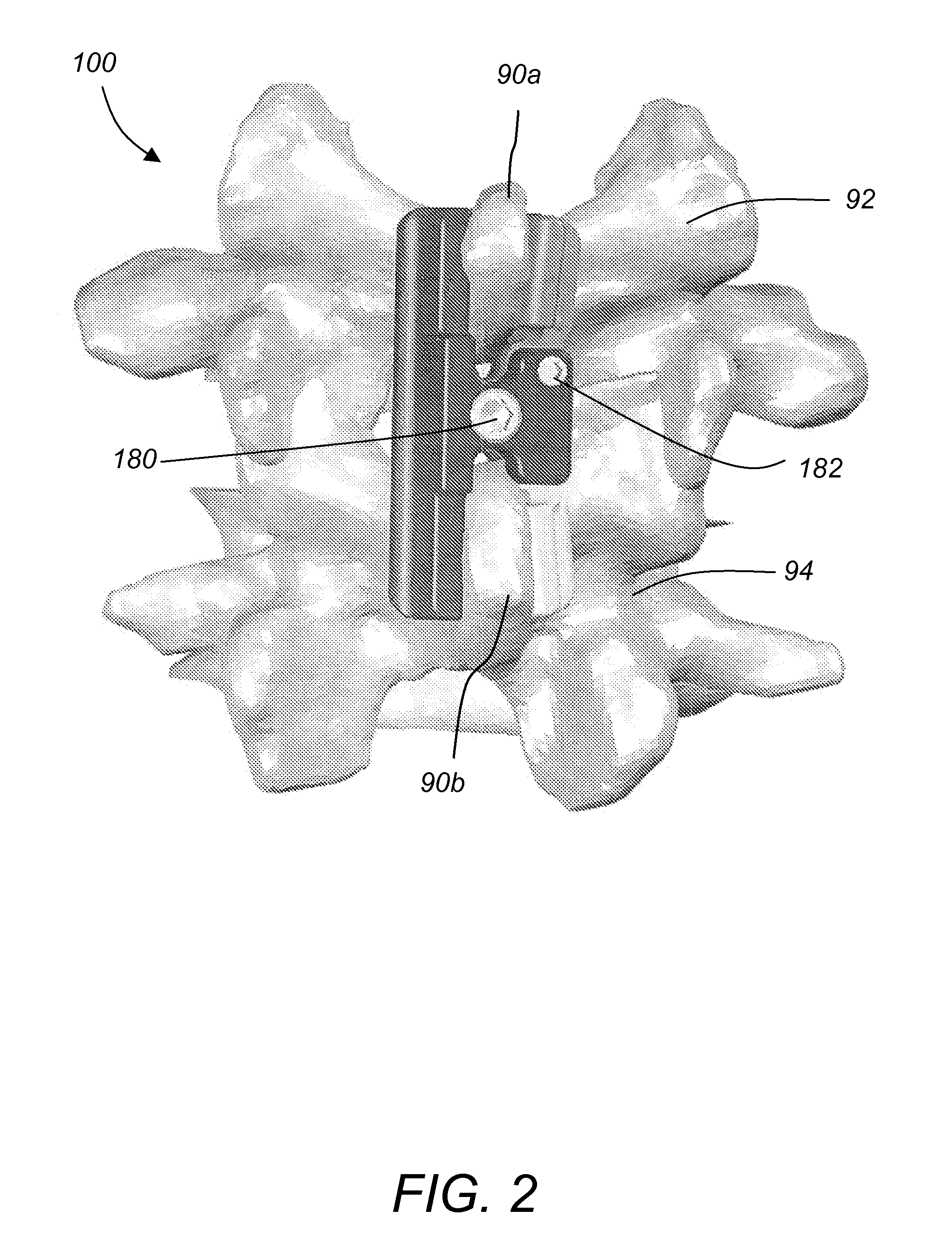 Spinous process fixation implant