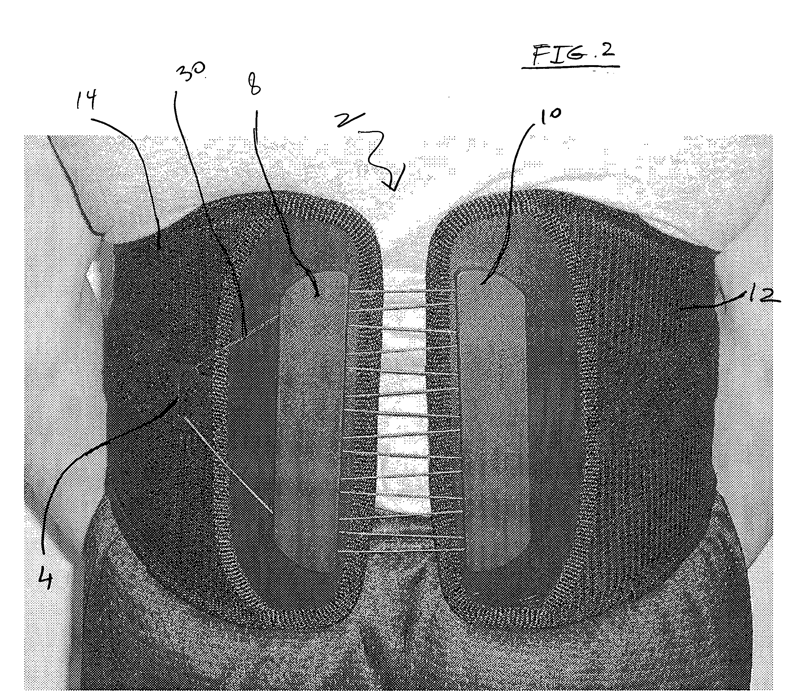 Orthosis closure system with mechanical advantage