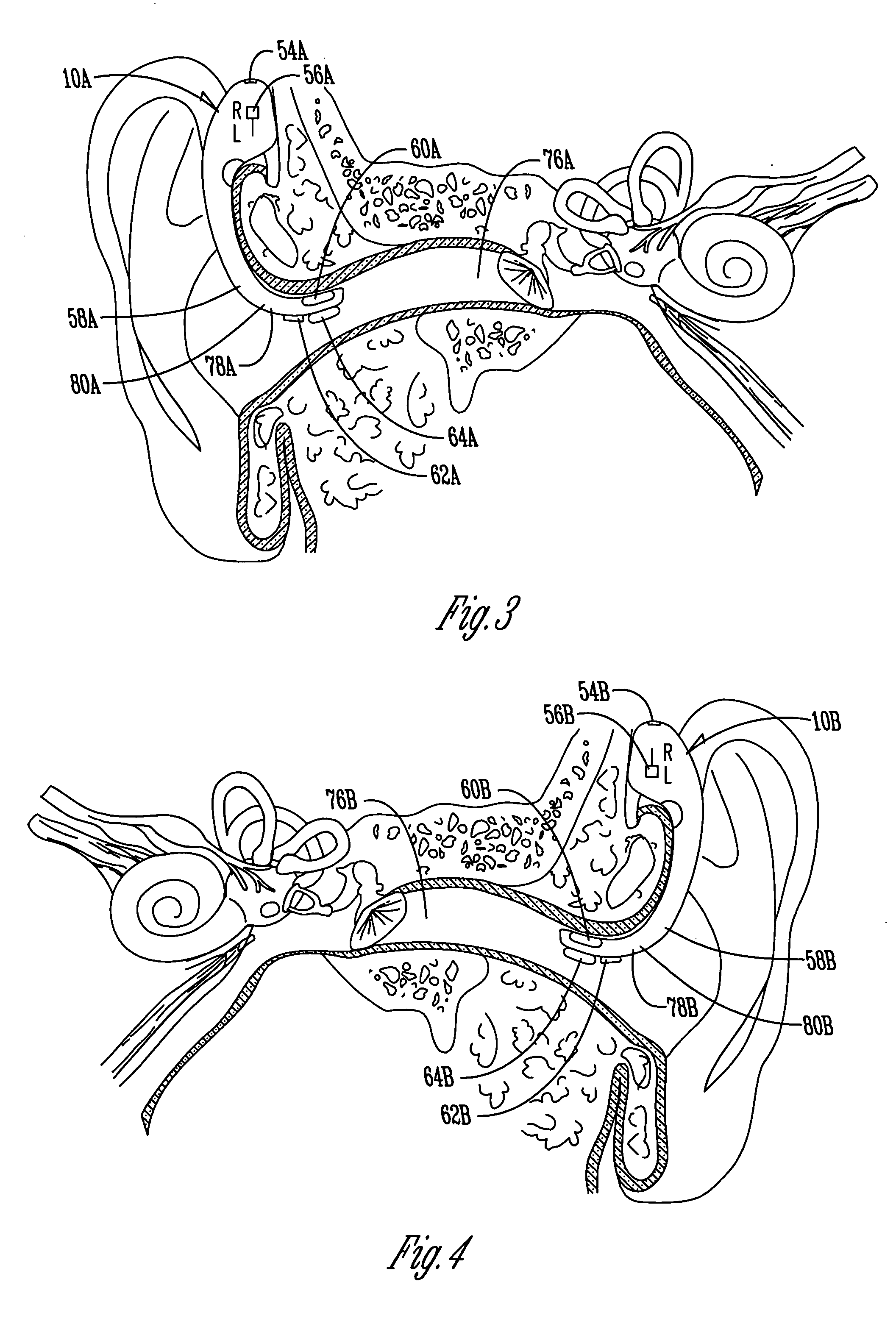 Dual ear voice communication device