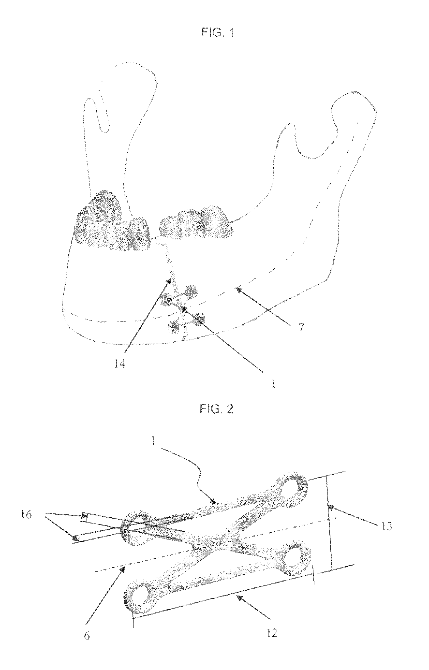 Osteosynthesis plate, method of customizing same, and method for installing same