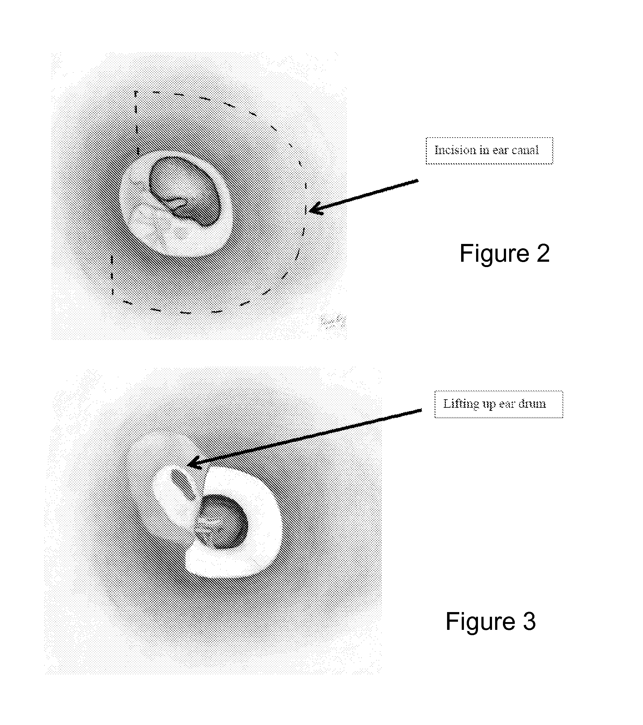 System and method to locally deliver therapeutic agent to inner ear