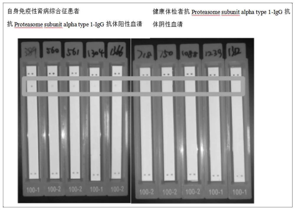 A kit for detecting anti-proteasome subunit α1-igg antibody