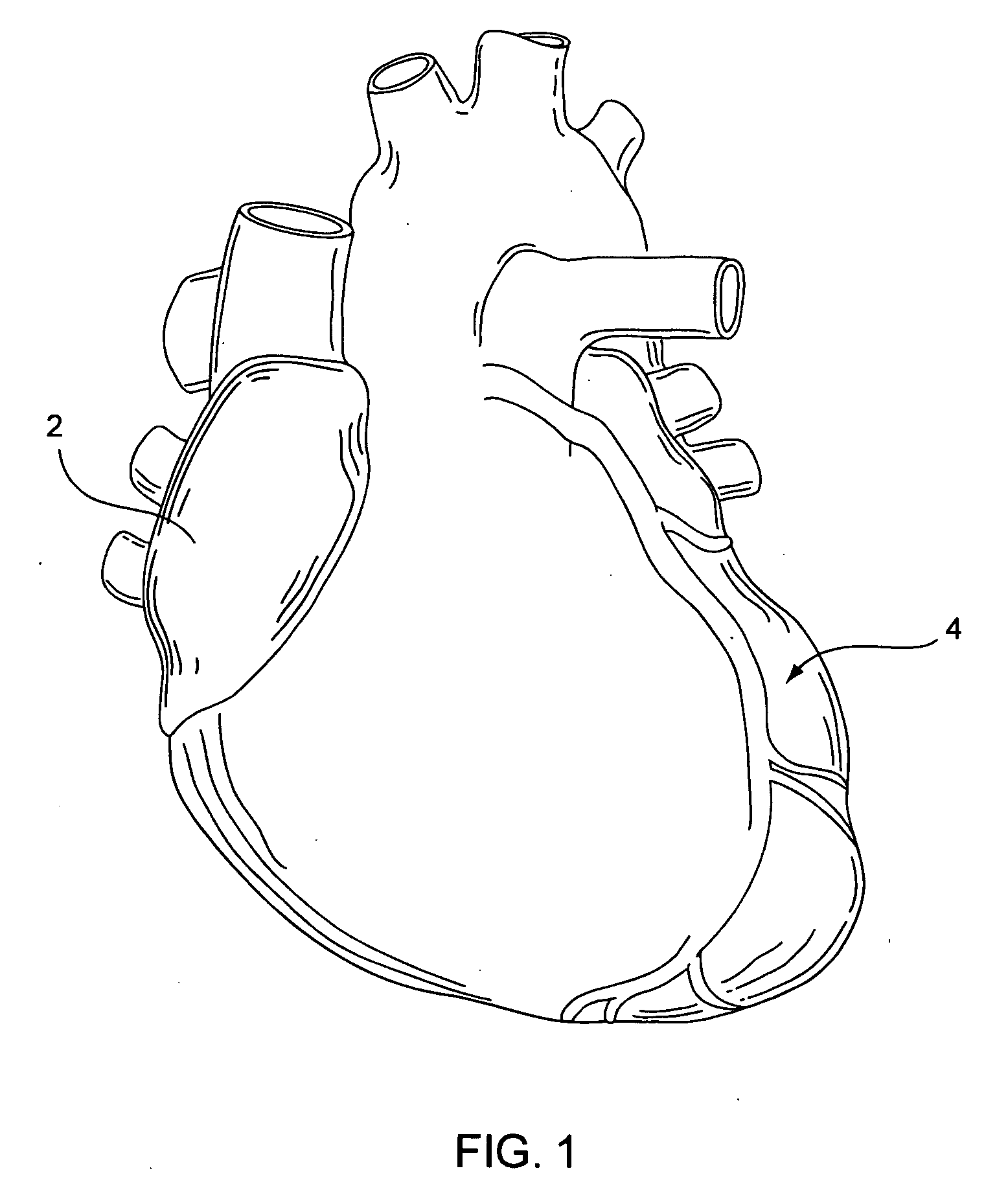 Staged stent delivery systems