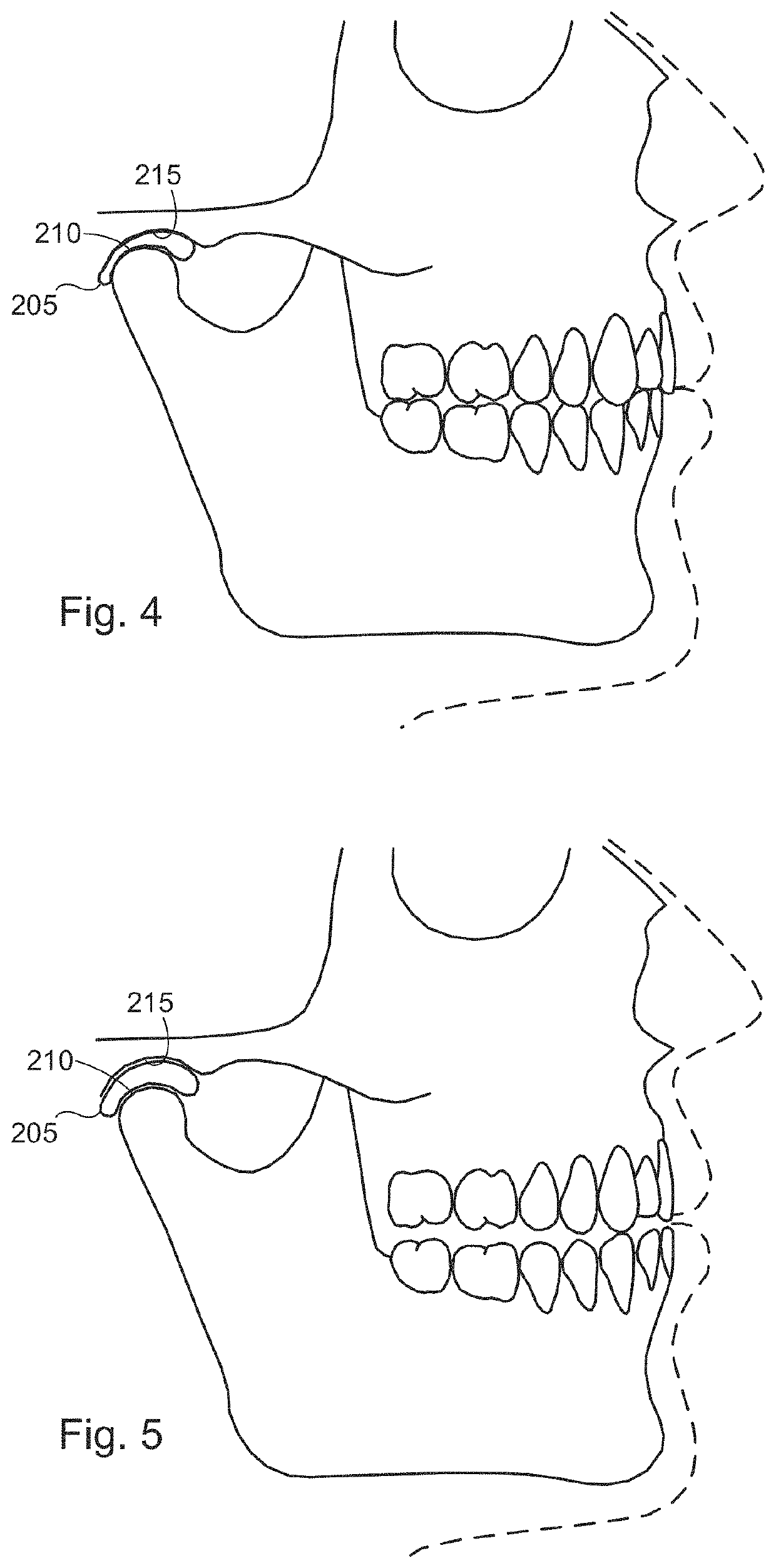 User-customizable orthopedic alignment device with alignment gap