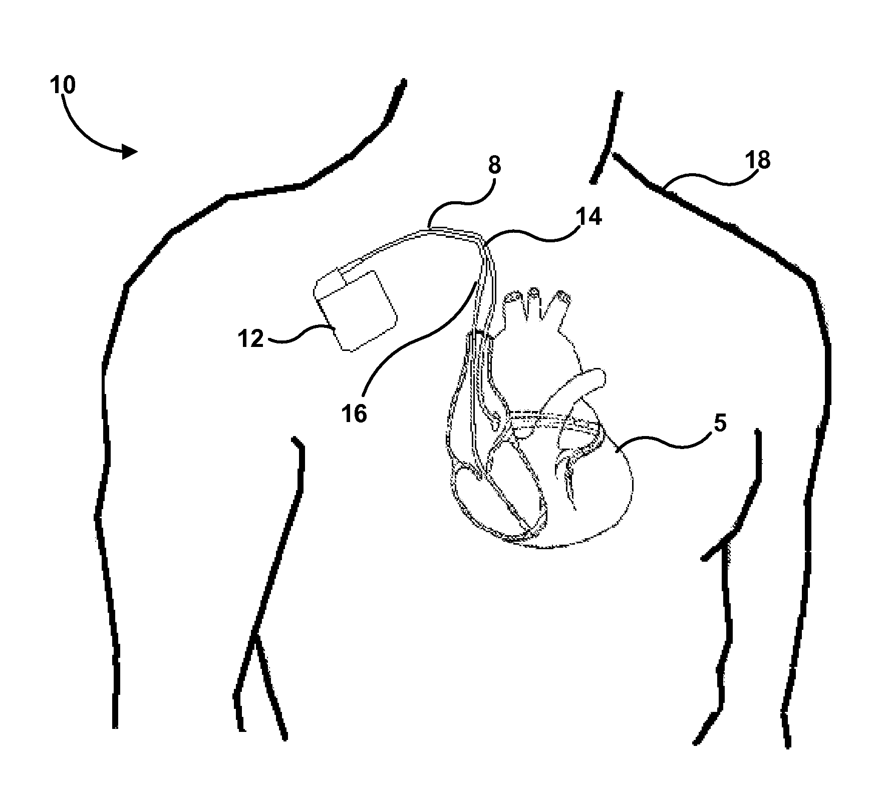 Implantable medical lead with biased electrode