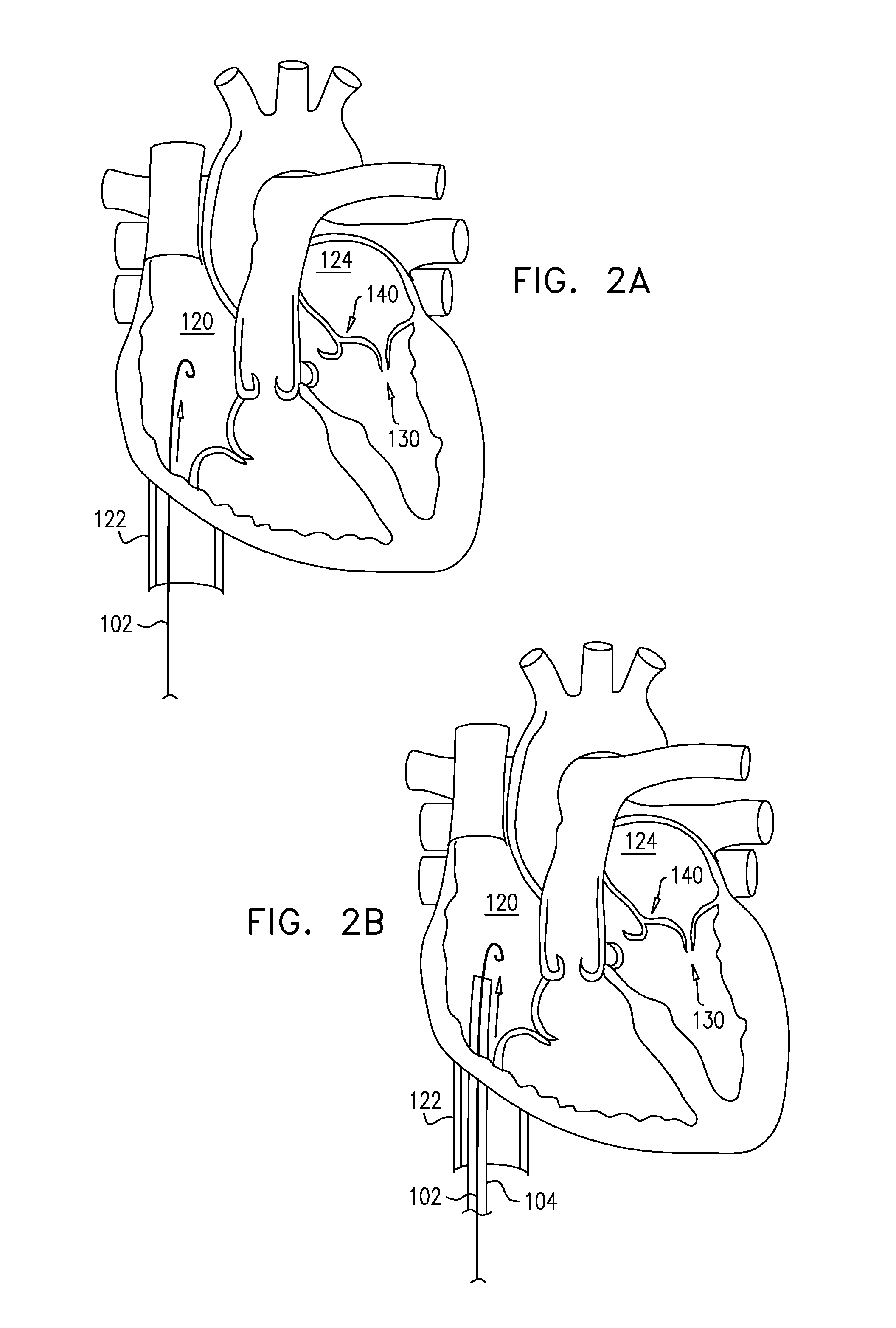 Closed band for percutaneous annuloplasty