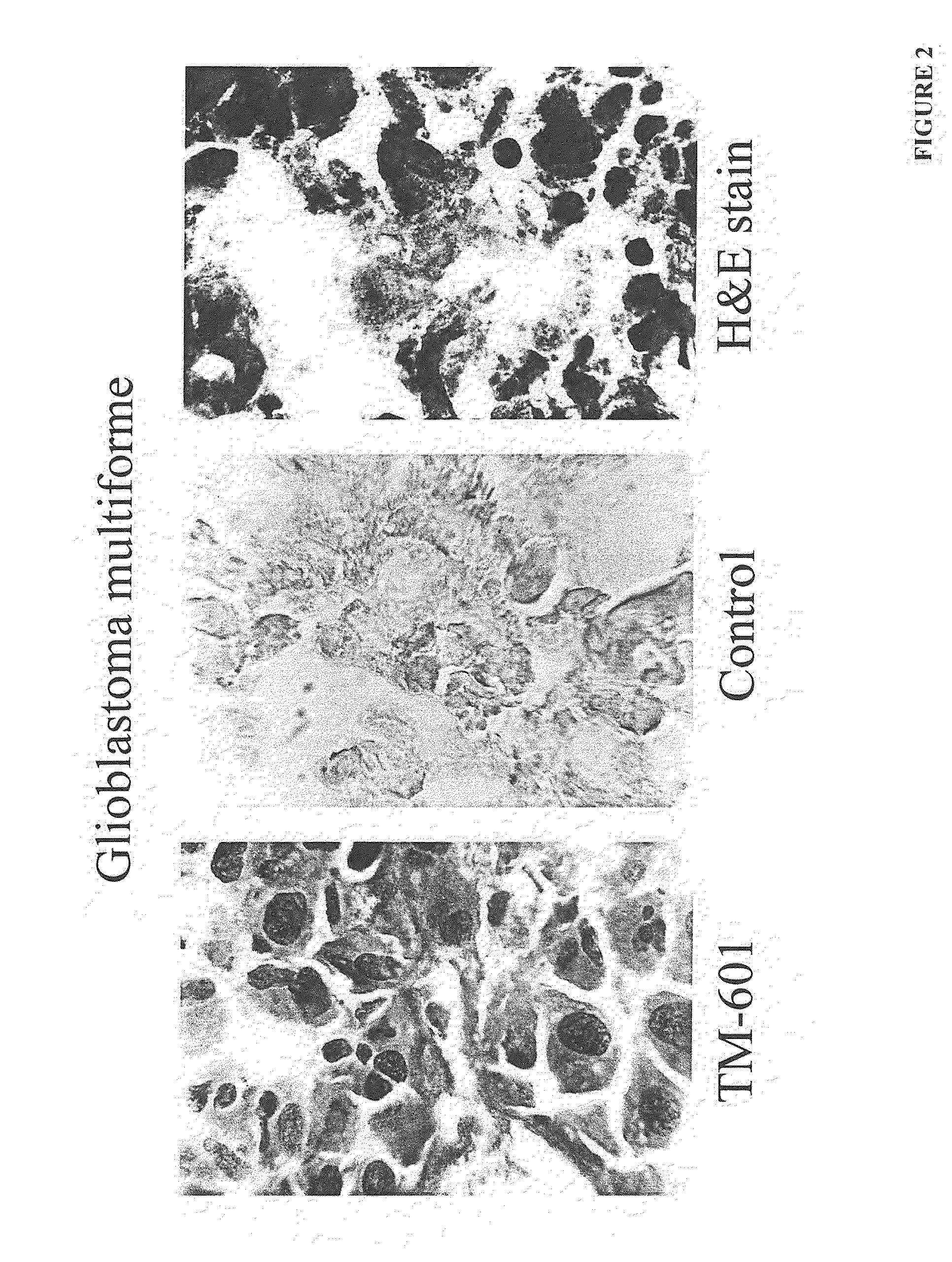 Diagnosis and treatment of neuroectodermal tumors