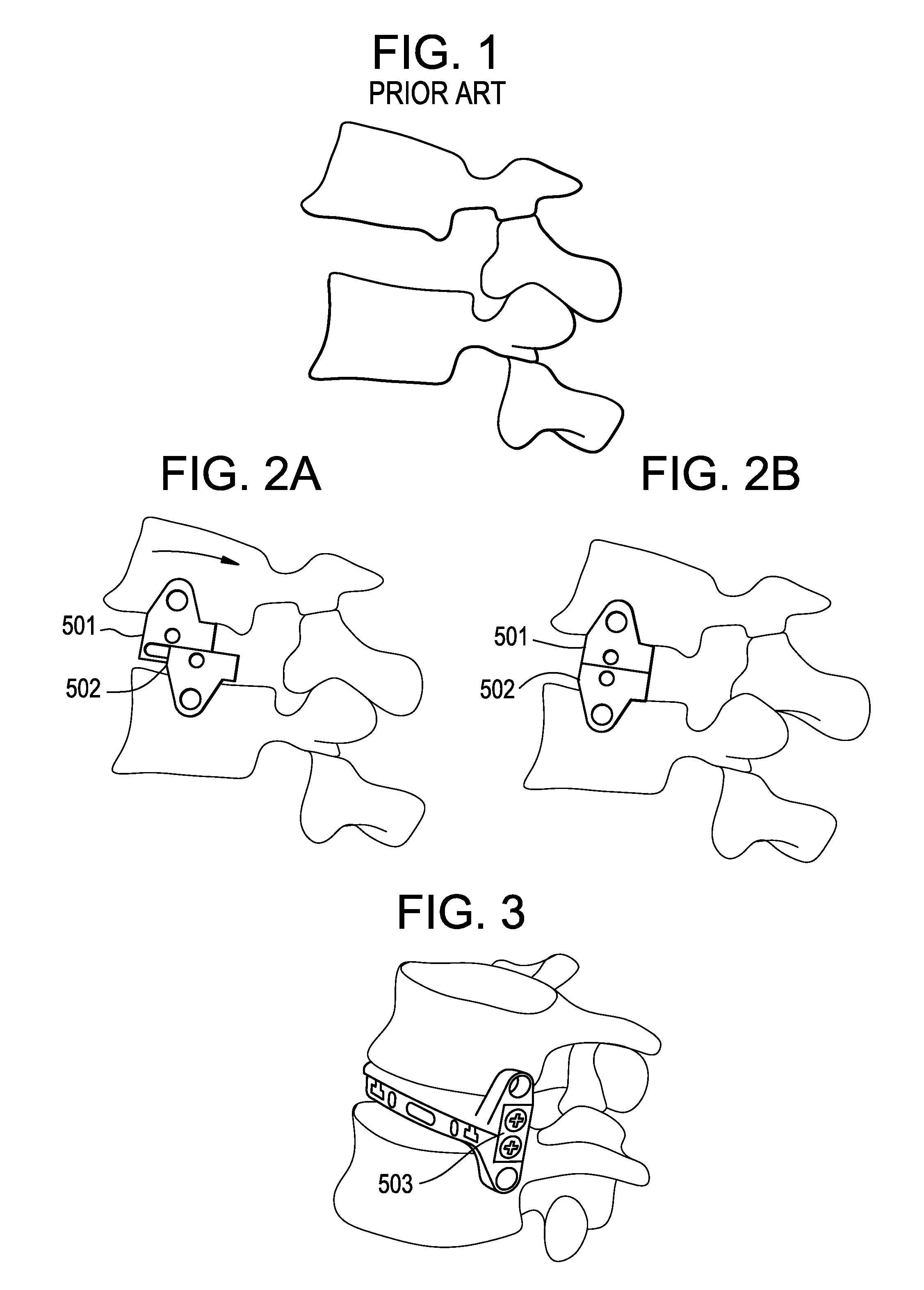 Lateral spondylolisthesis reduction cage