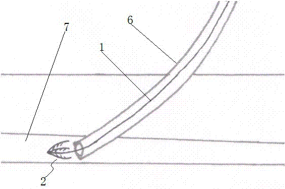 Human pathological or iatrogenic cavity blocking device