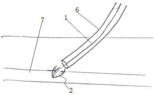 Human pathological or iatrogenic cavity blocking device