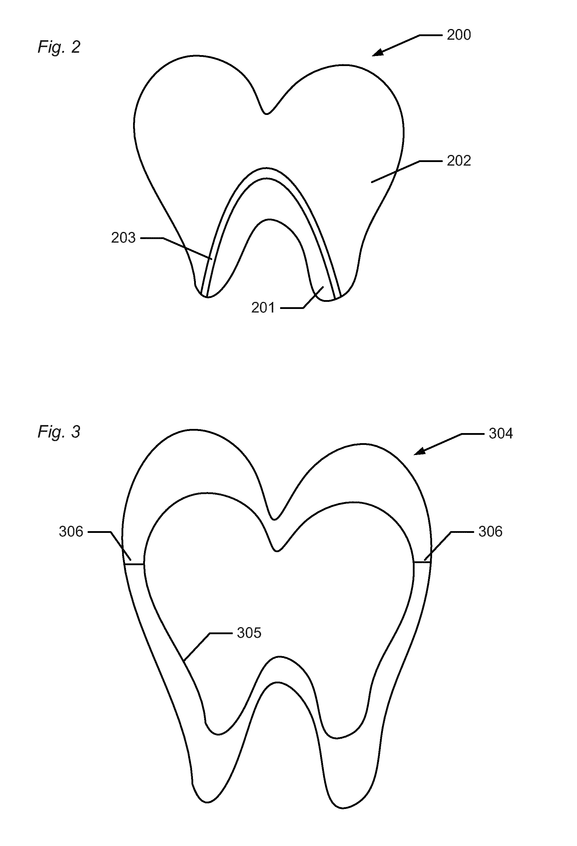 Mould for dental restoration